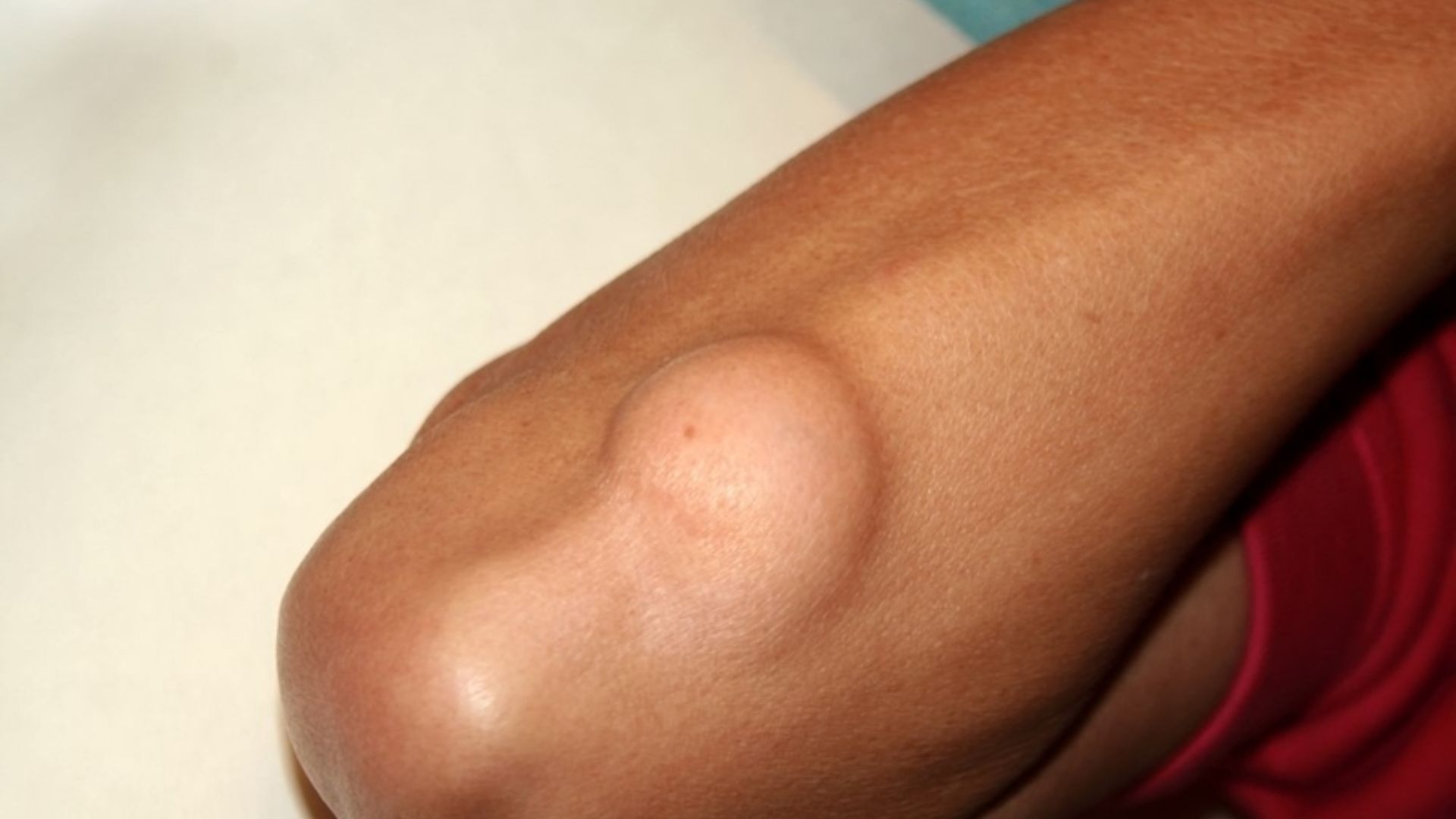 U mỡ ở cánh tay là một khối u mềm và đa số là lành tính