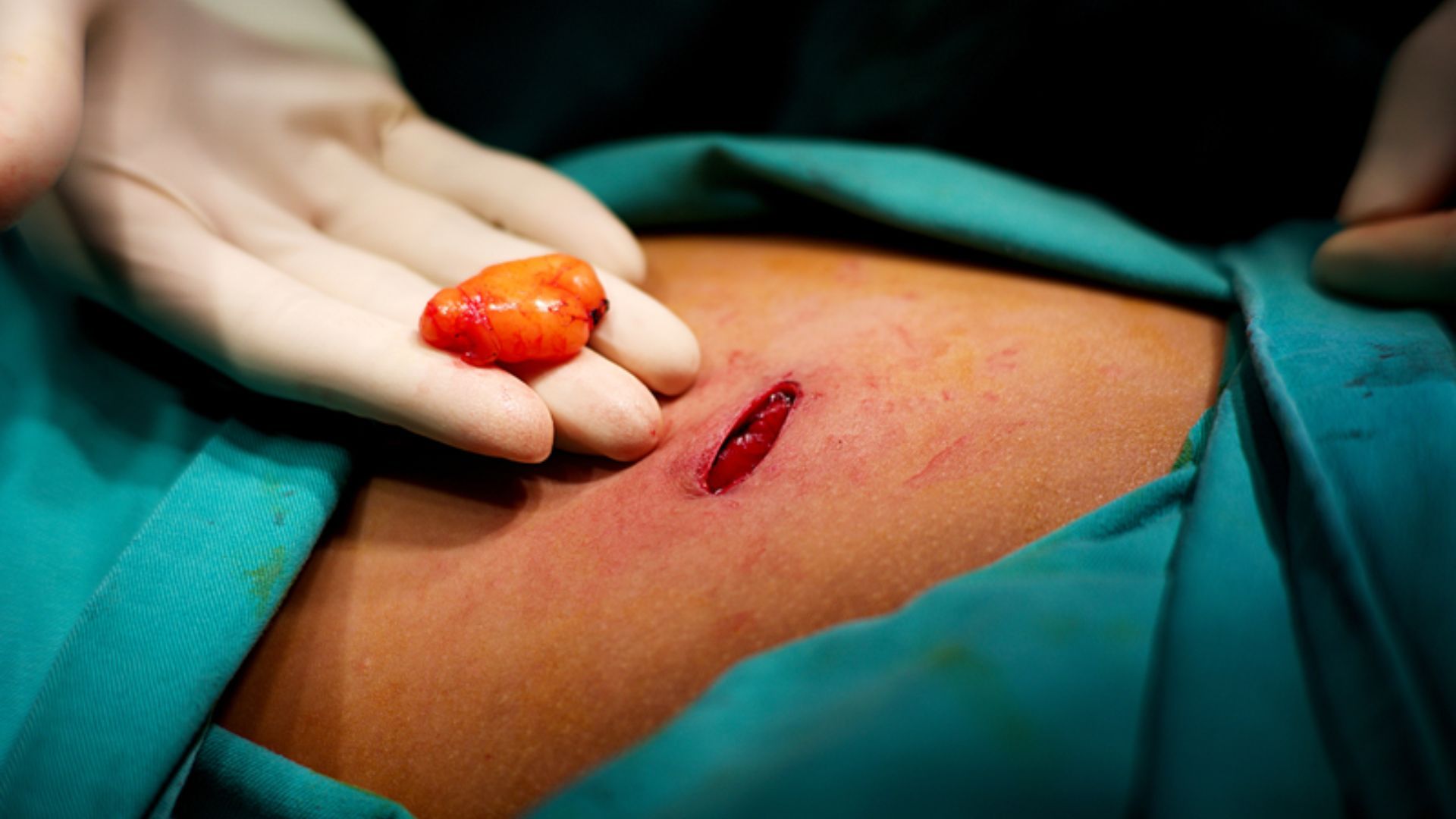 Phẫu thuật cắt bỏ u mỡ được chỉ định trong trường hợp khối u mỡ lớn