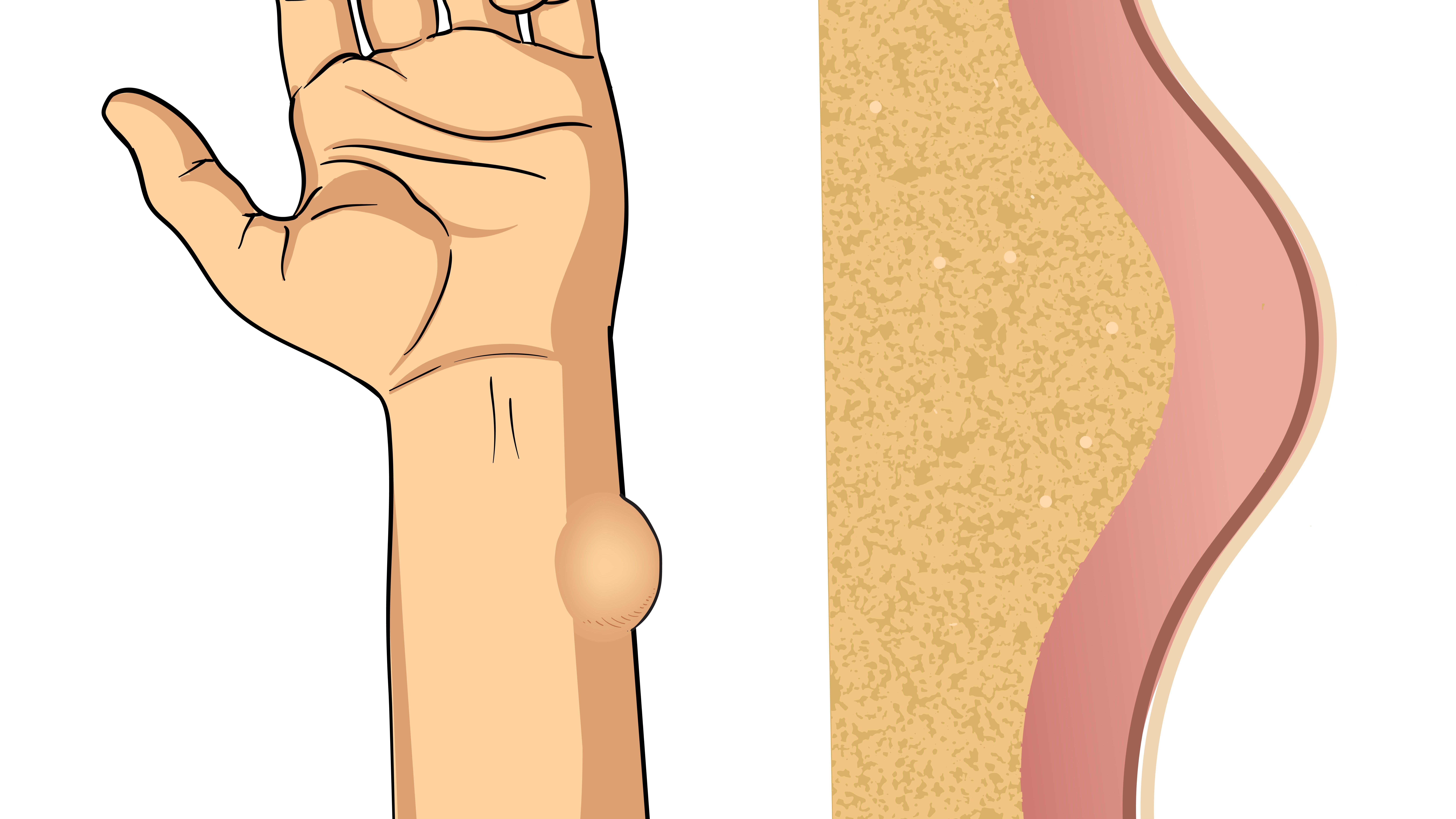 U mỡ dưới da là khối u lành tính mà không ít độc giả gặp phải