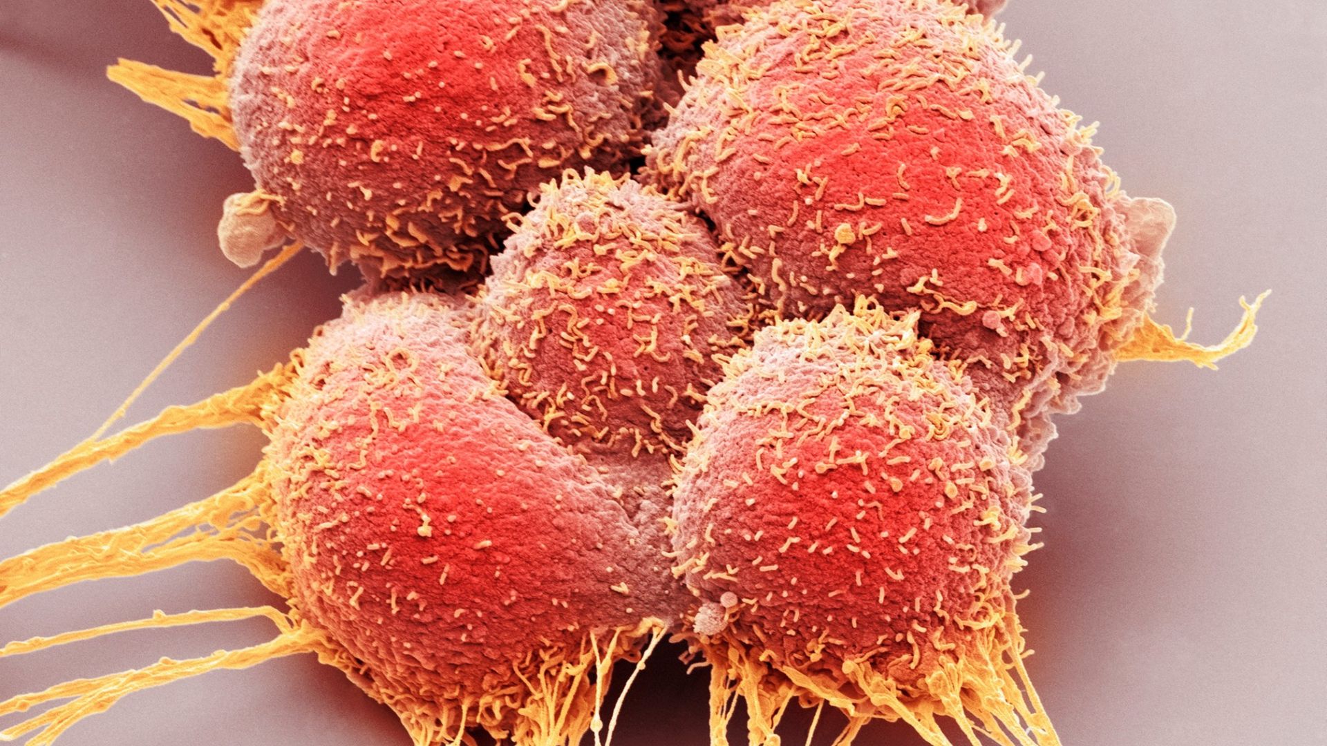 U mỡ là khối u lành tính hình thành do sự tăng sinh bất thường của các tế bào mỡ