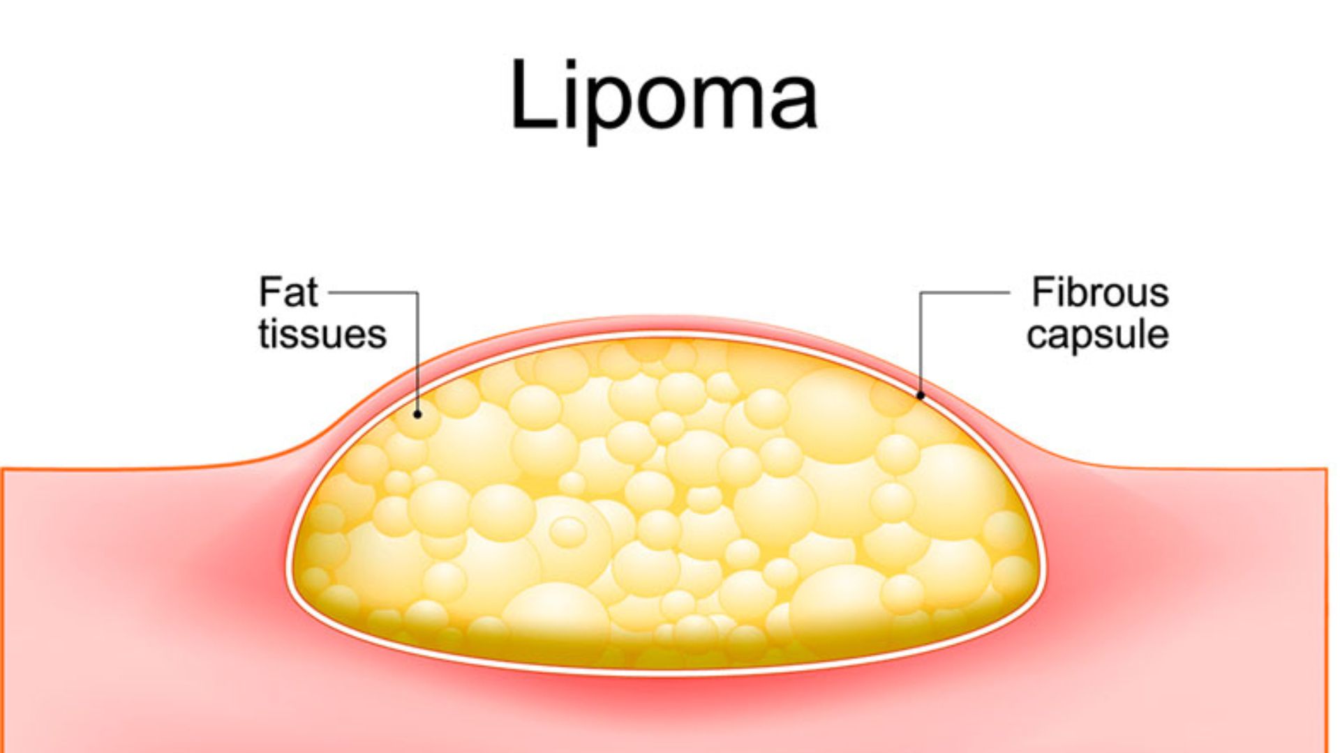 U mỡ ở bụng là tình trạng mà không ít độc giả gặp phải