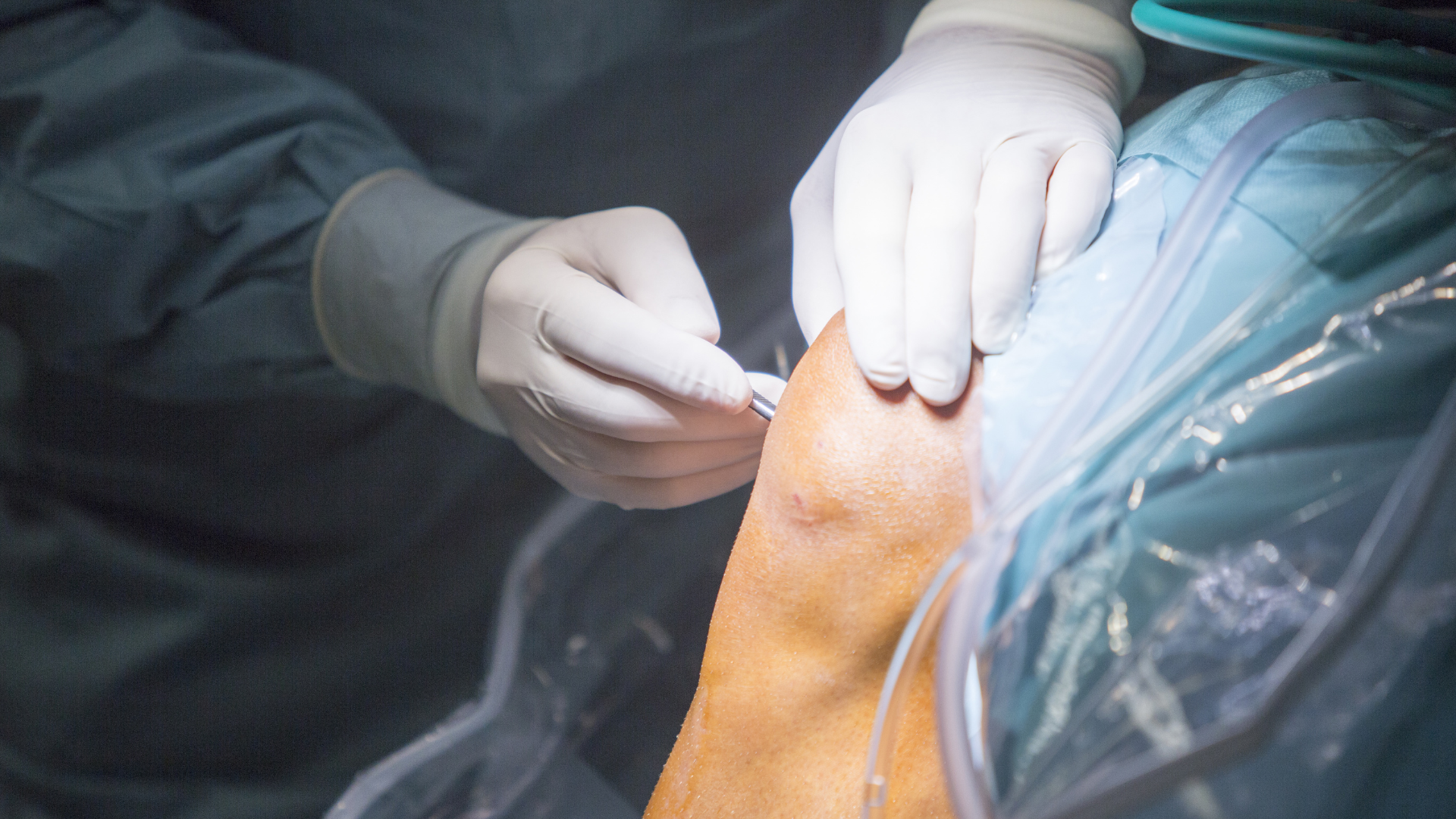 Phẫu thuật thường chỉ được cân nhắc khi các phương pháp khác không hiệu quả