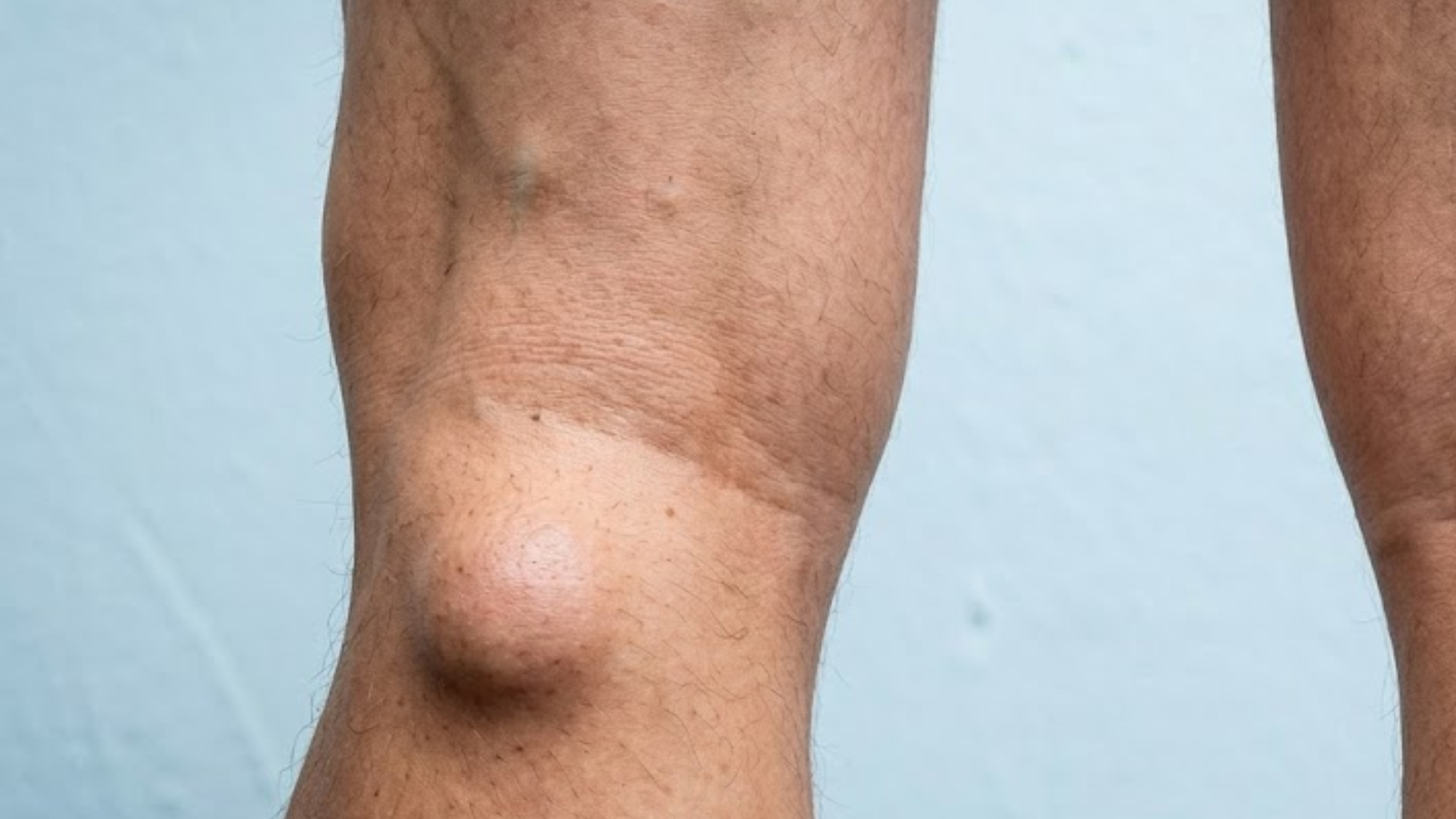 U nang bao hoạt dịch khớp gối có thể tạo thành khối sưng ở vùng phía sau hoặc quanh khớp