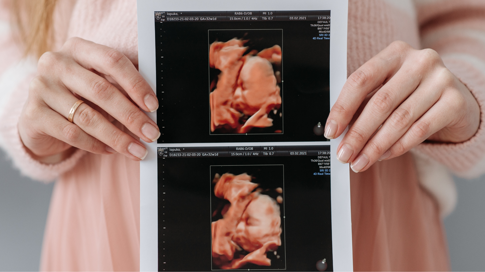 U nang buồng trứng có thai được không? 3