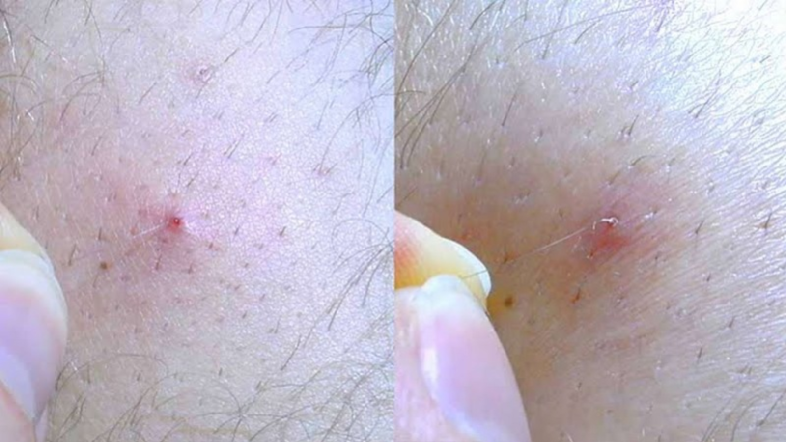 U nang lông là gì? Những thông tin quan trọng cần biết 2