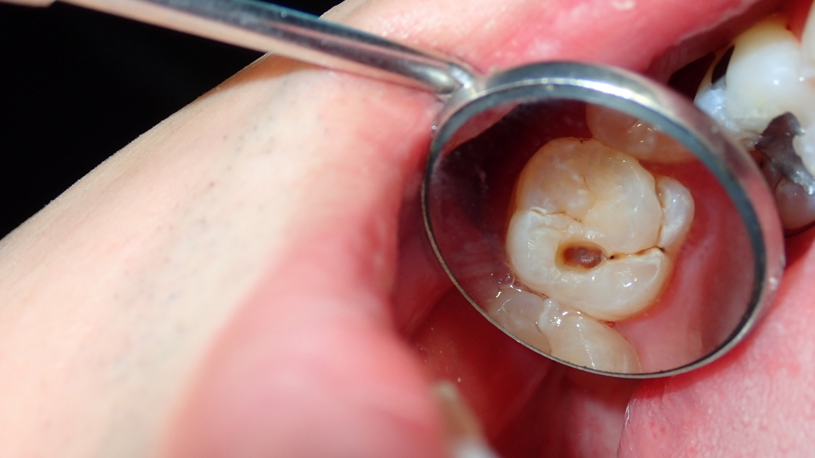 U nang răng là gì? Những thông tin quan trọng cần biết 2