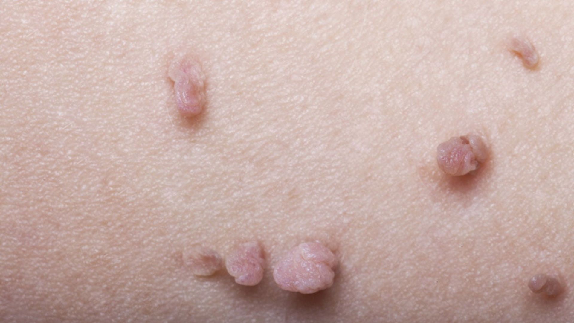 U nhú là gì? Nguyên nhân, triệu chứng và cách điều trị