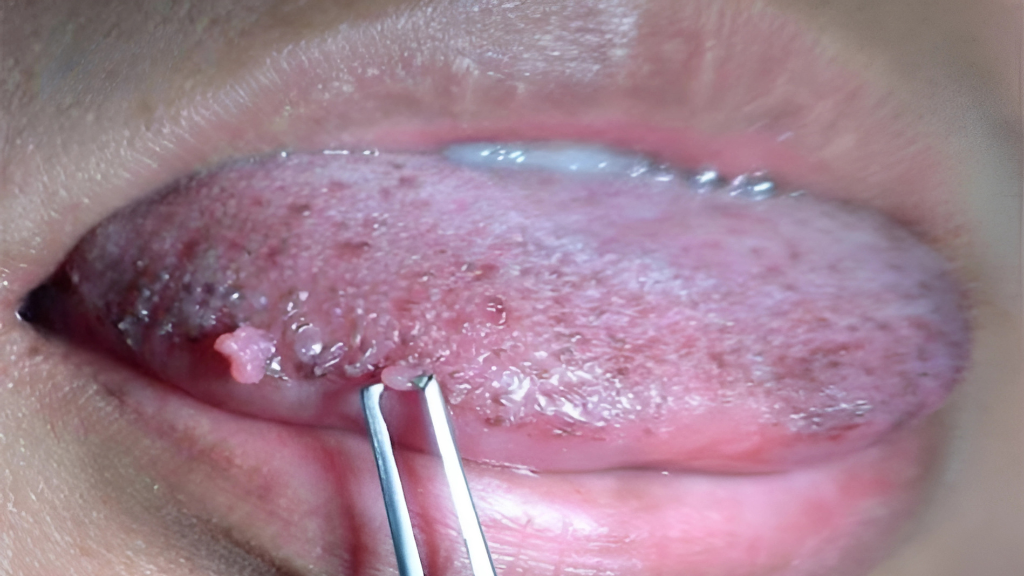 U nhú tiền đình ở lưỡi là gì? Cách phân biệt với sùi mào gà 2
