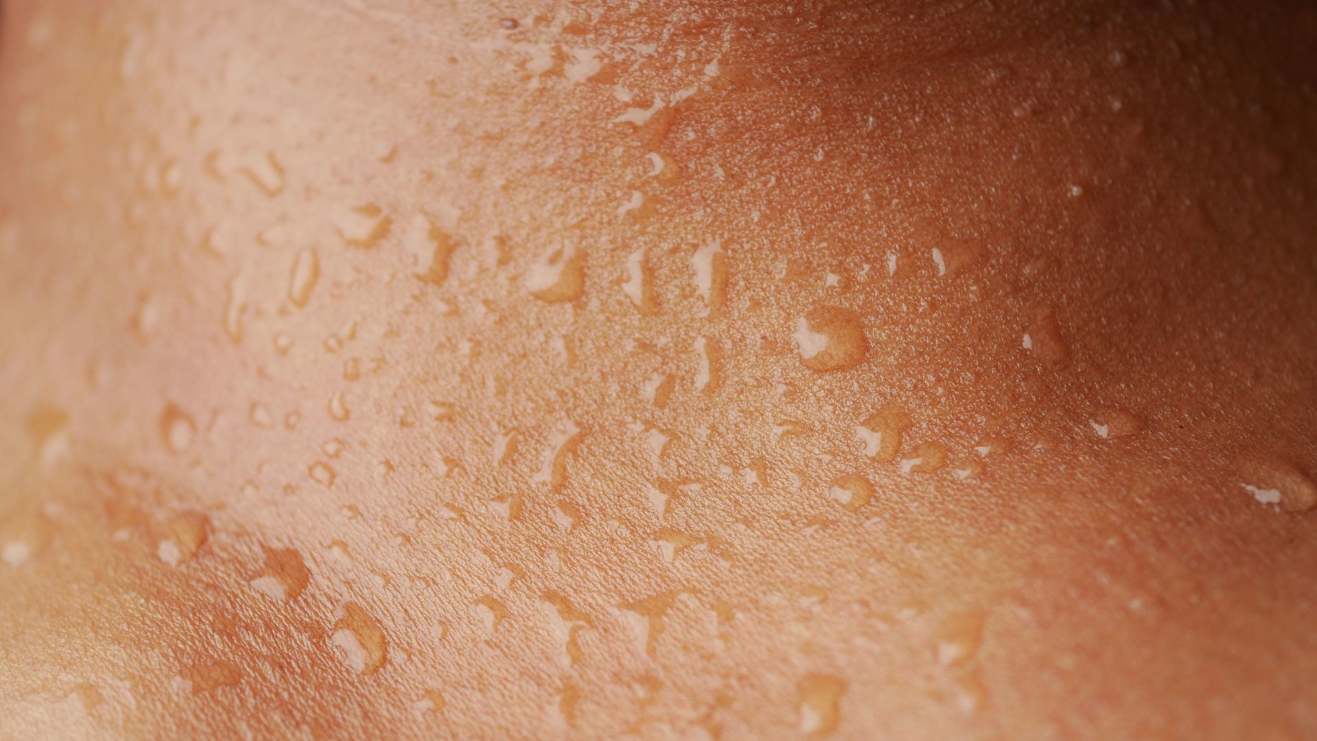 Dấu hiệu thường gặp của u ống tuyến mồ hôi là các nốt nhỏ xuất hiện âm thầm trên bề mặt da