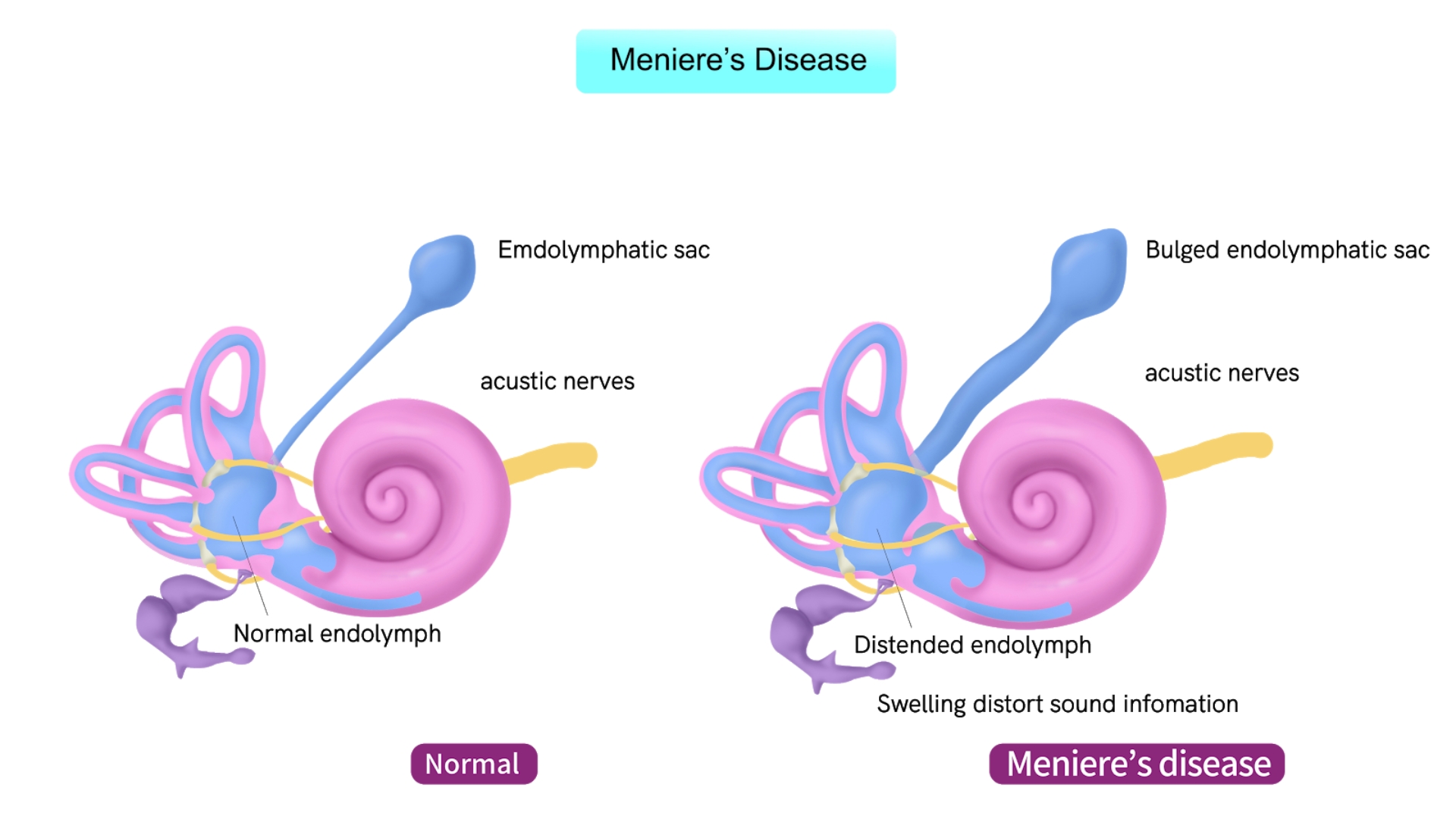 Ù tai phải có thể xuất hiện do bệnh Meniere