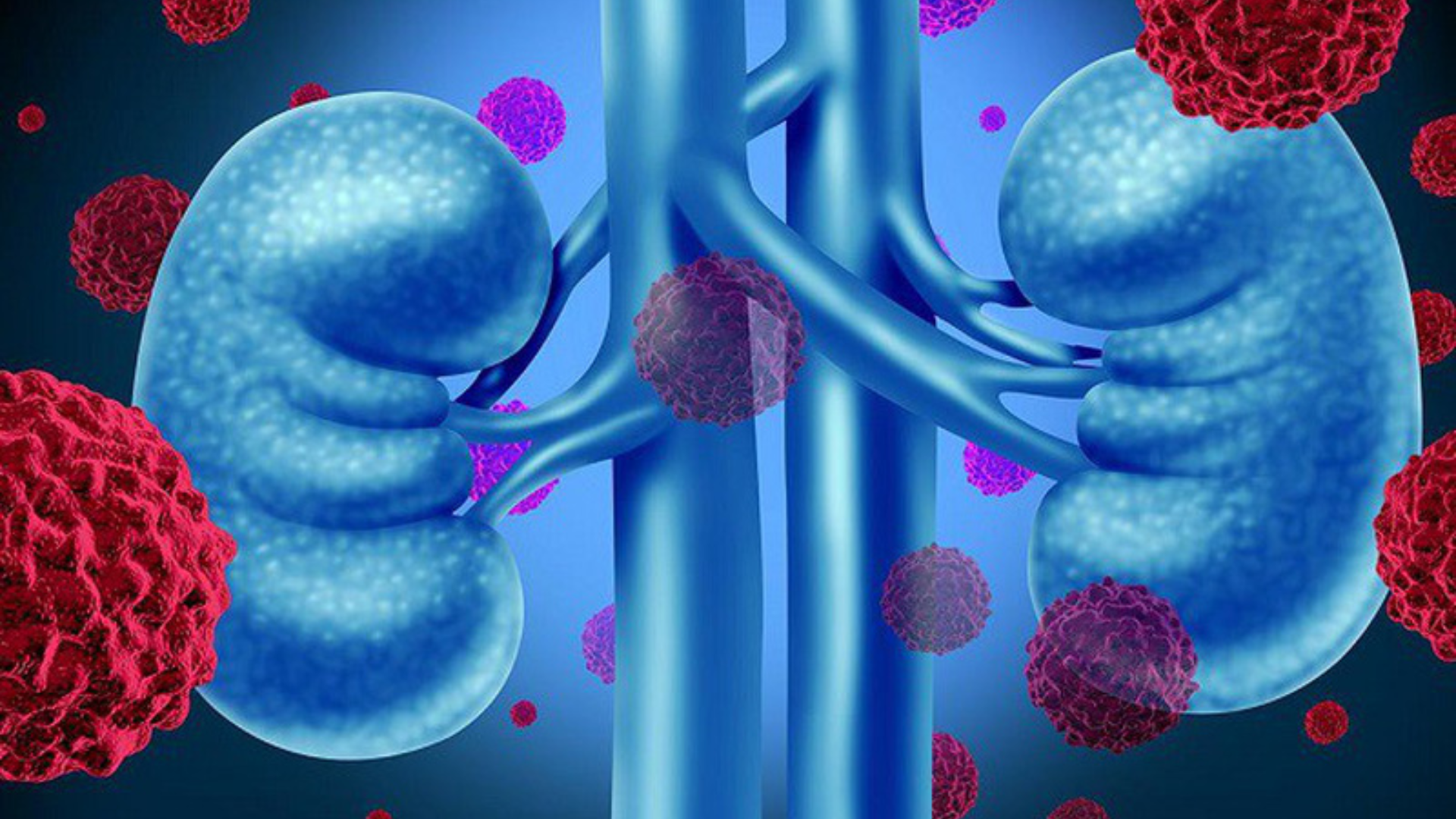 U thận ác tính phát triển lặng lẽ, có thể kéo dài nhiều năm, xâm lấn và di căn xa