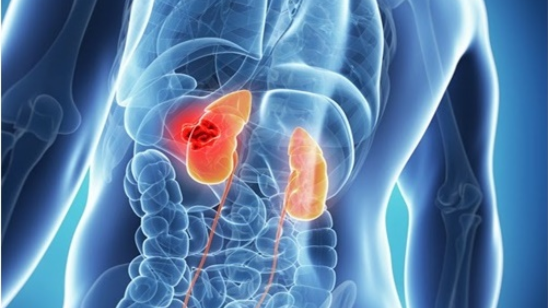 Khi bệnh bước sang giai đoạn 3, khối u xâm lấn mô xung quanh, sức khỏe người bệnh bị ảnh hưởng rõ