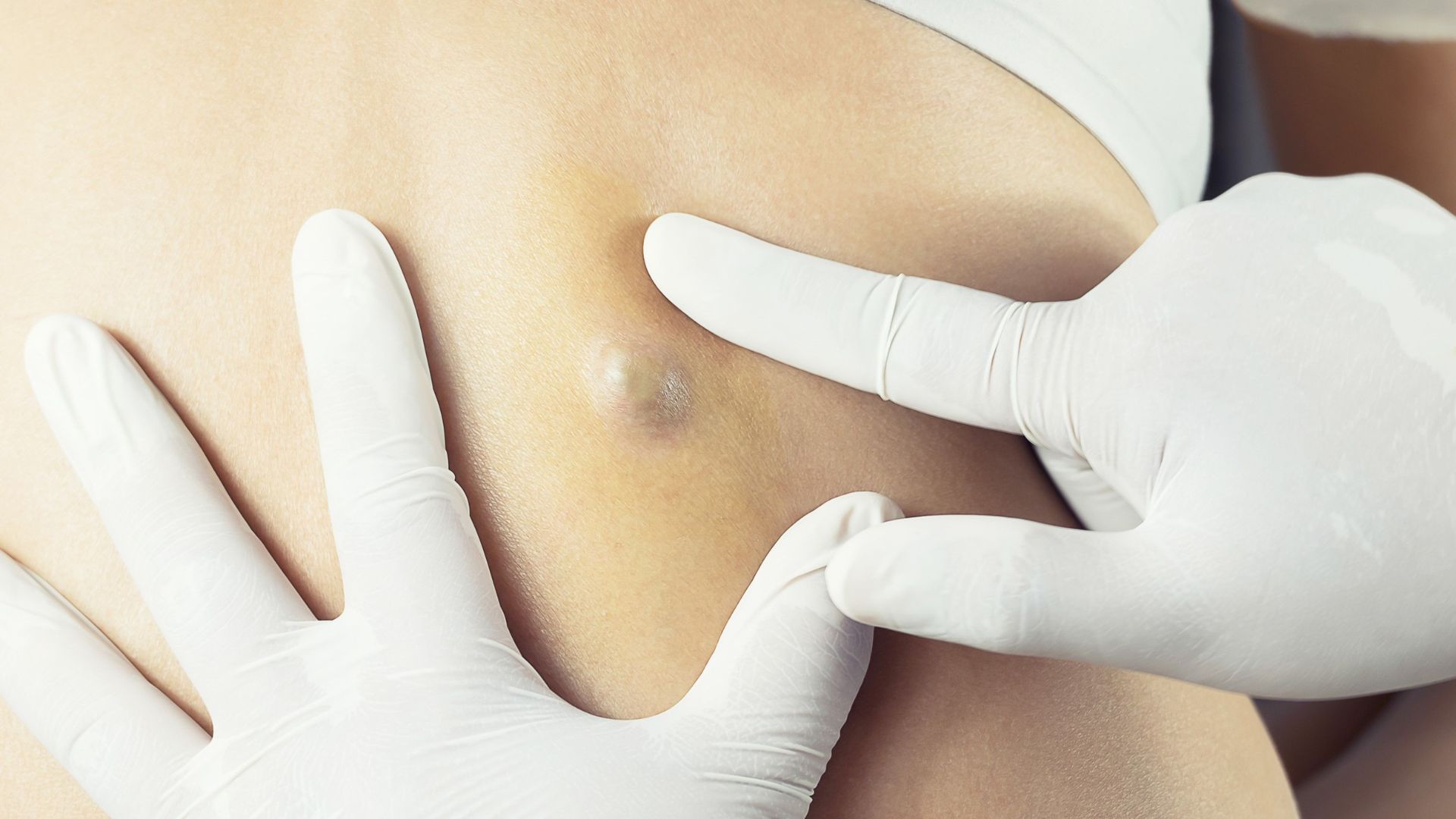 Nổi 1 cục nhỏ dưới da là biểu hiện thường gặp của u tuyến bã nhờn