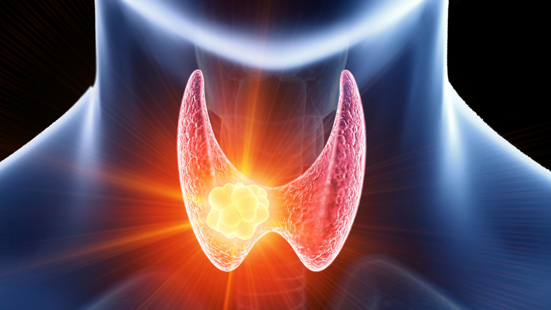 Giải thích mức độ nguy hiểm của u tuyến giáp dựa trên các yếu tố đặc trưng