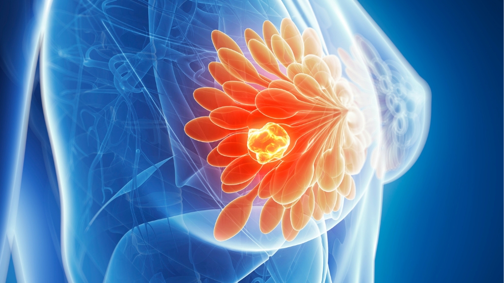 Các nguyên nhân thường thấy có thể khiến khối u xuất hiện ở vú