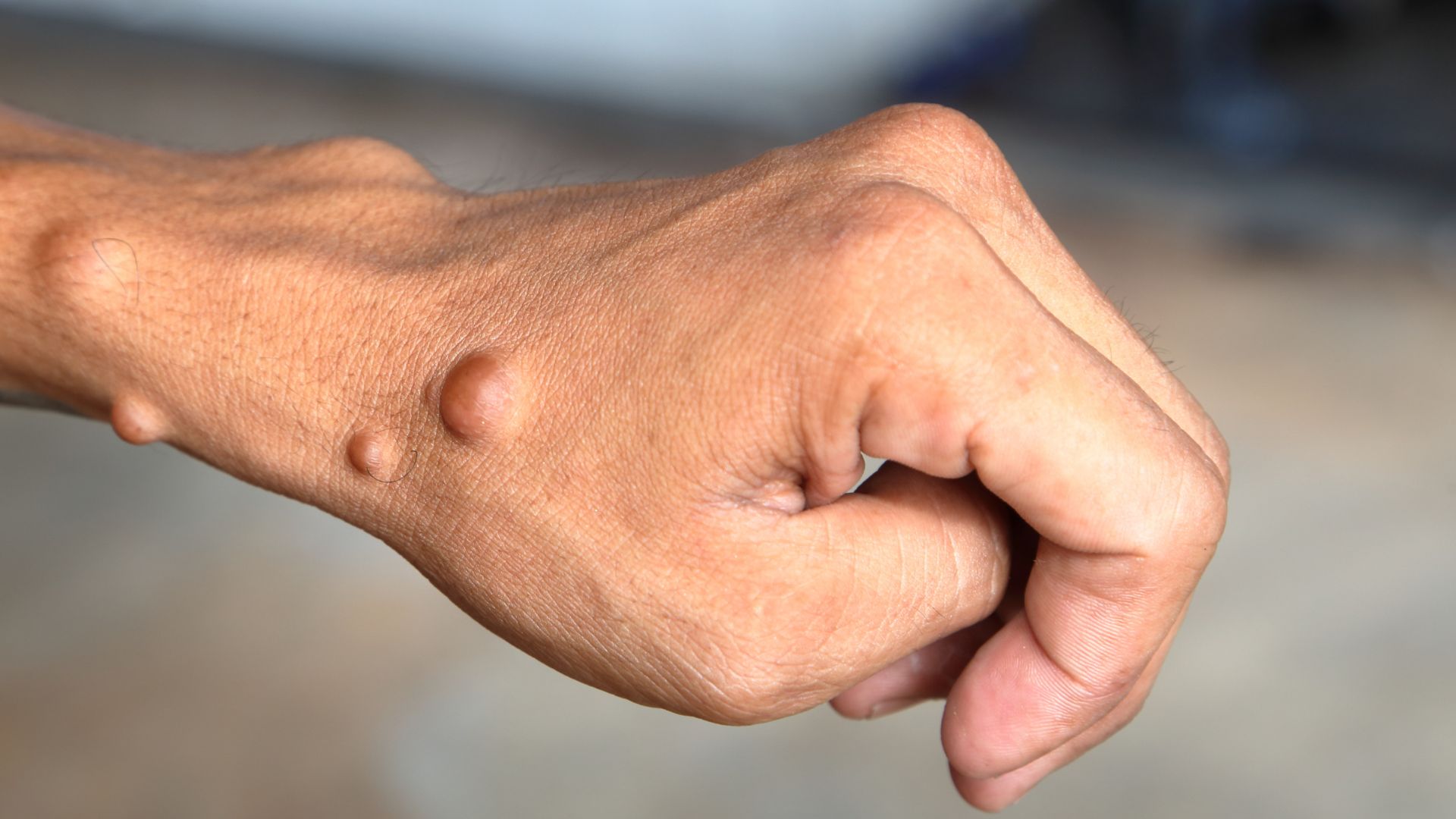 Dấu hiệu thường gặp nhất là các khối u mềm, nổi gồ trên bề mặt da hoặc nằm dưới da