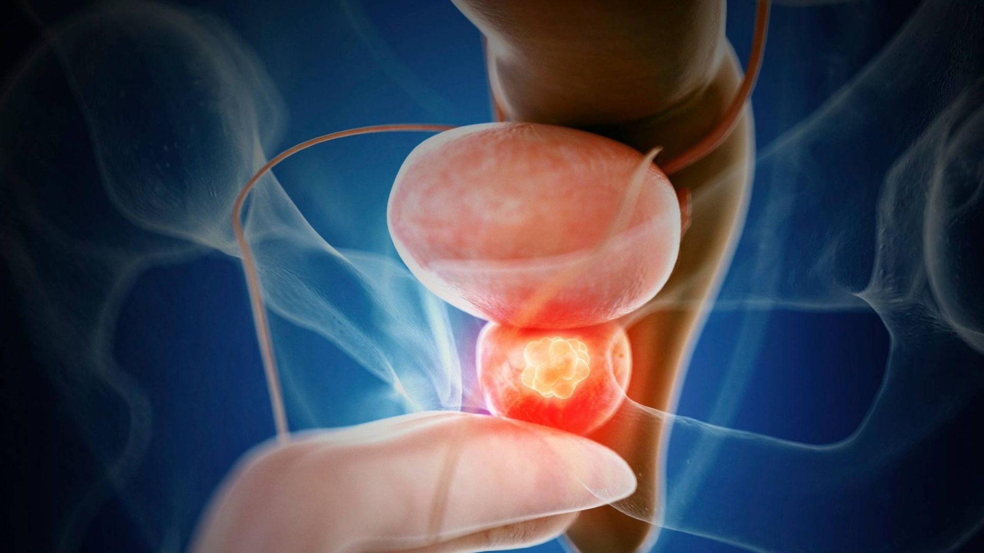 Không phải tất cả các trường hợp u xơ tiền liệt tuyến đều cần phẫu thuật