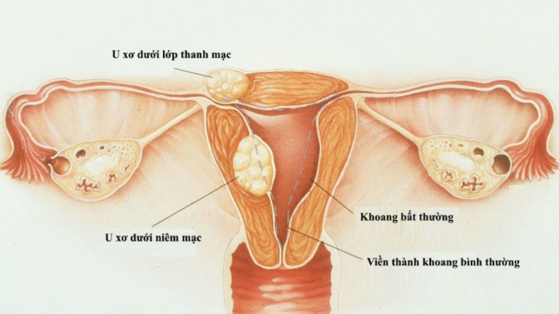 U xơ tử cung dưới thanh mạc: Nguyên nhân, triệu chứng và cách điều trị-1