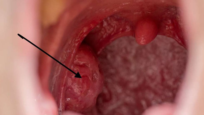 Ung thư amidan giai đoạn đầu là tình trạng tế bào ác tính bắt đầu hình thành và phát triển khu trú tại amidan