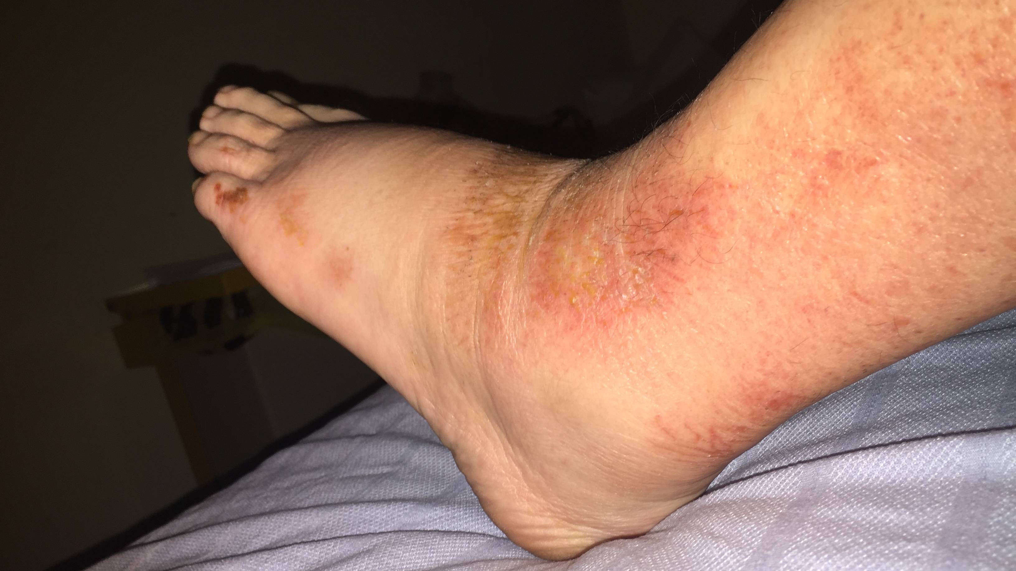 Phù bạch huyết chi dưới là một biến chứng nghiêm trọng do ung thư cổ tử cung gây ra