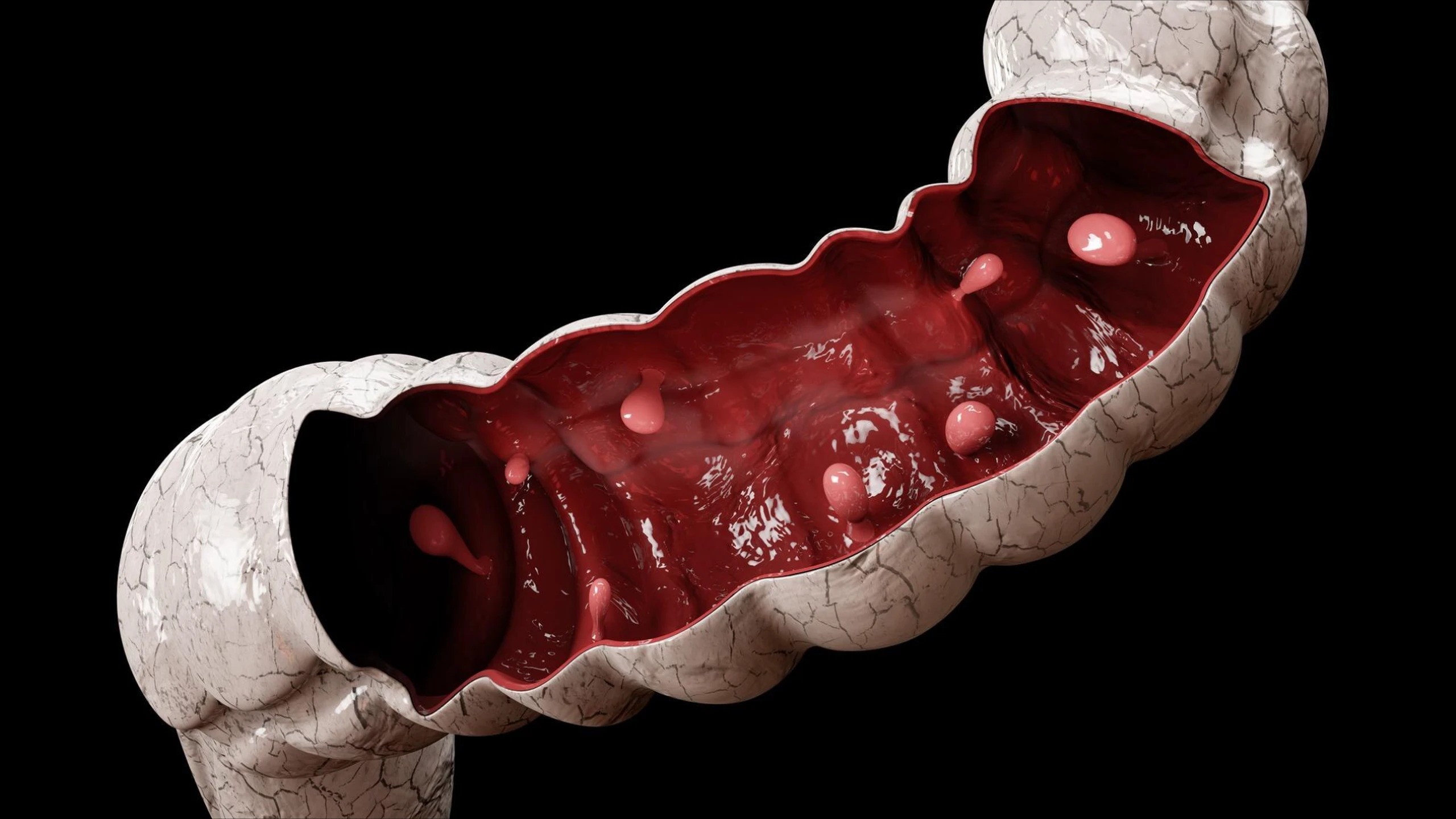 Bạn sẽ có thể có nguy cơ mắc ung thư đại tràng cao hơn nếu có tiền sử bị polyp đại tràng