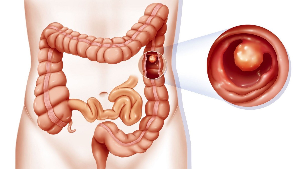 Polyp đại tràng có thể tiến triển thành ung thư đại tràng di căn