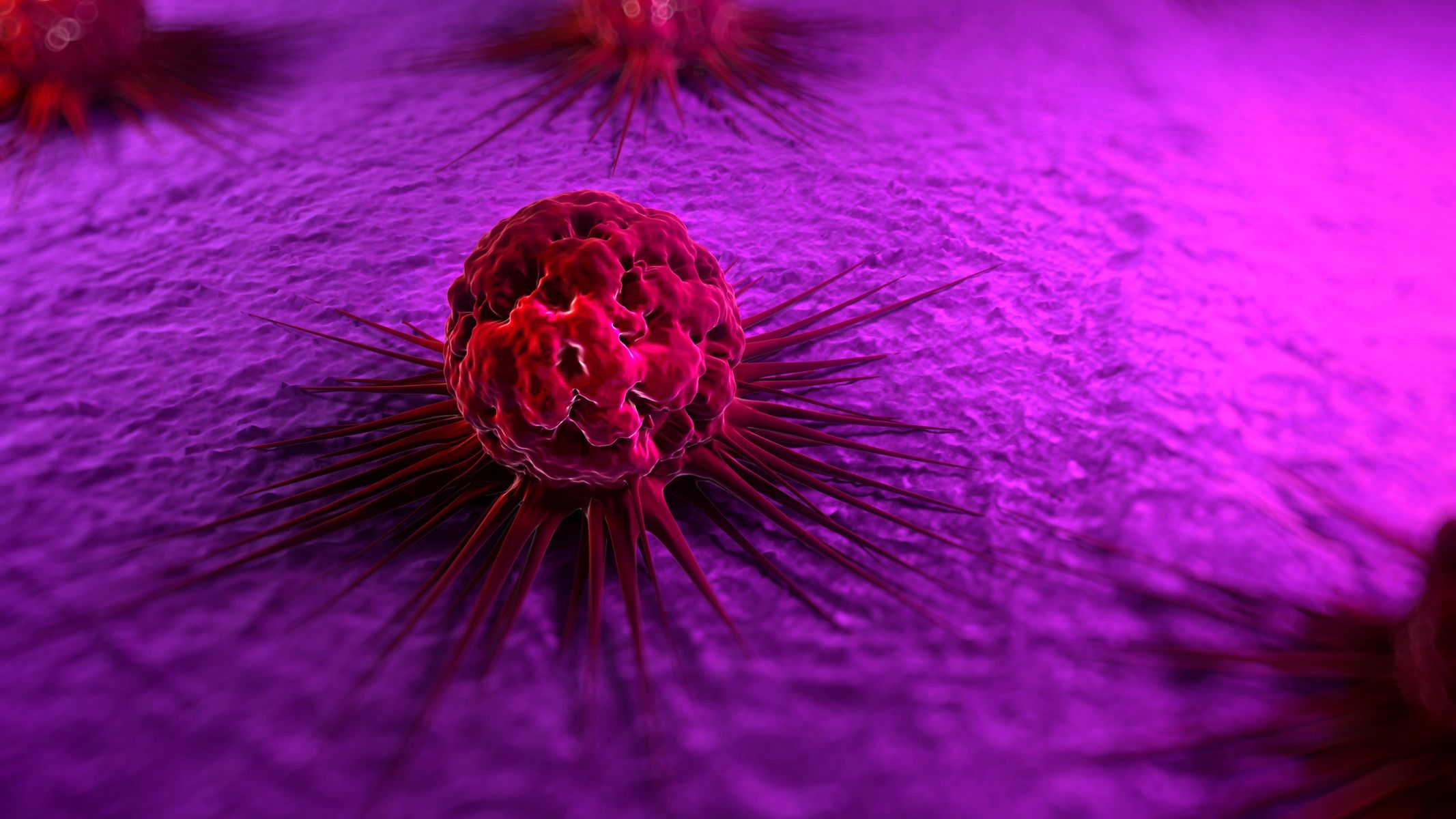 Ung thư di căn xương có chữa được không?