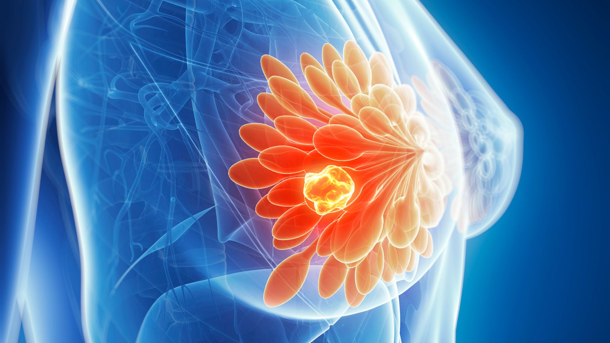 Ung thư vú có xu hướng đáp ứng tốt với điều trị so với một vài loại ung thư khác