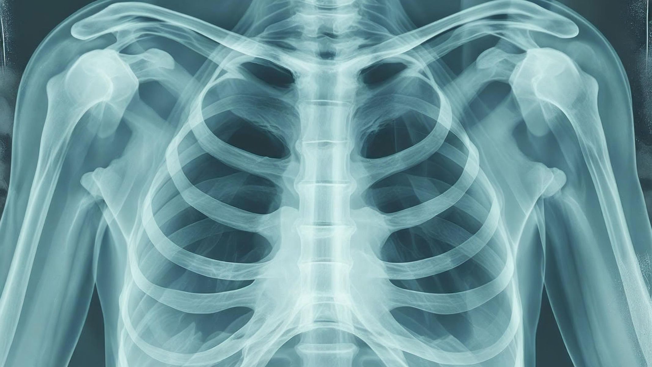 Xương dễ gãy là triệu chứng thường gặp khi mắc ung thư di căn xương