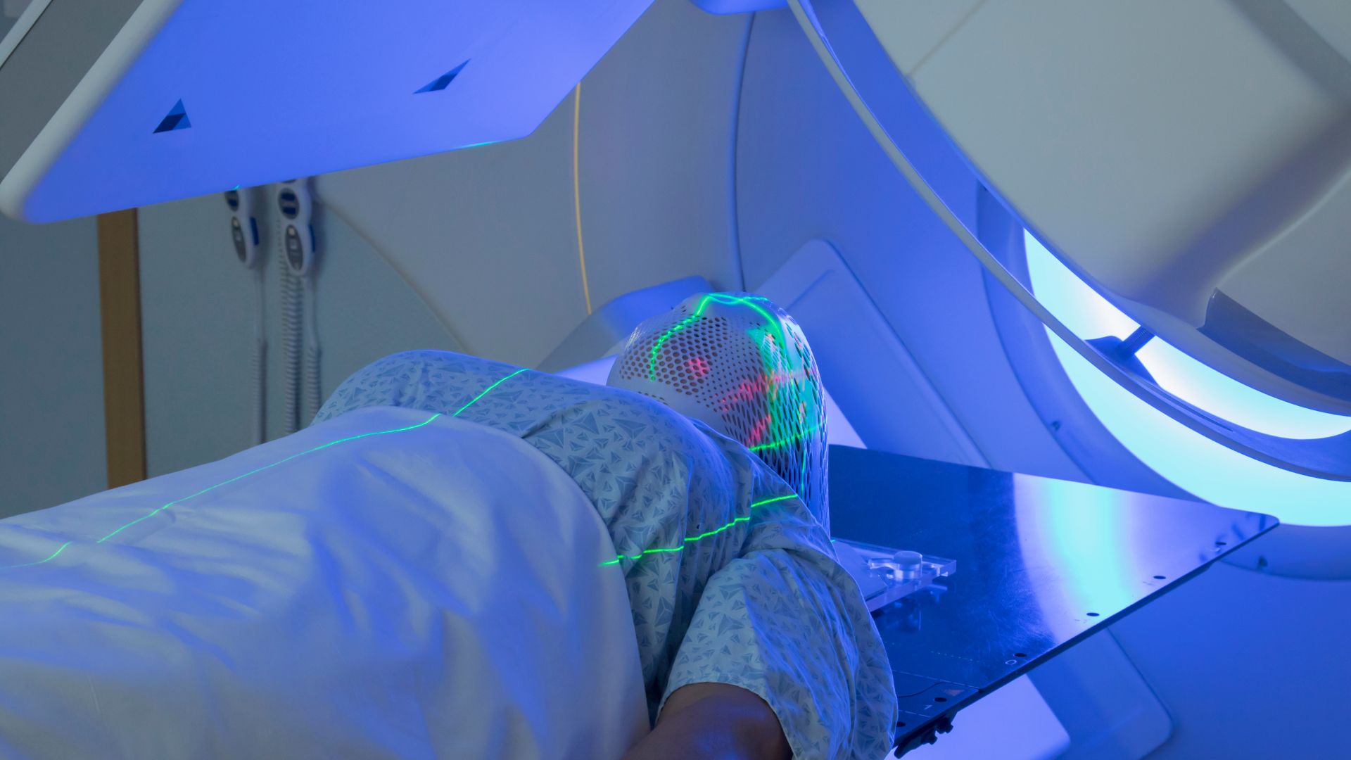 Xạ trị là một phương pháp được áp dụng trong điều trị ung thư phổi đã di căn xương