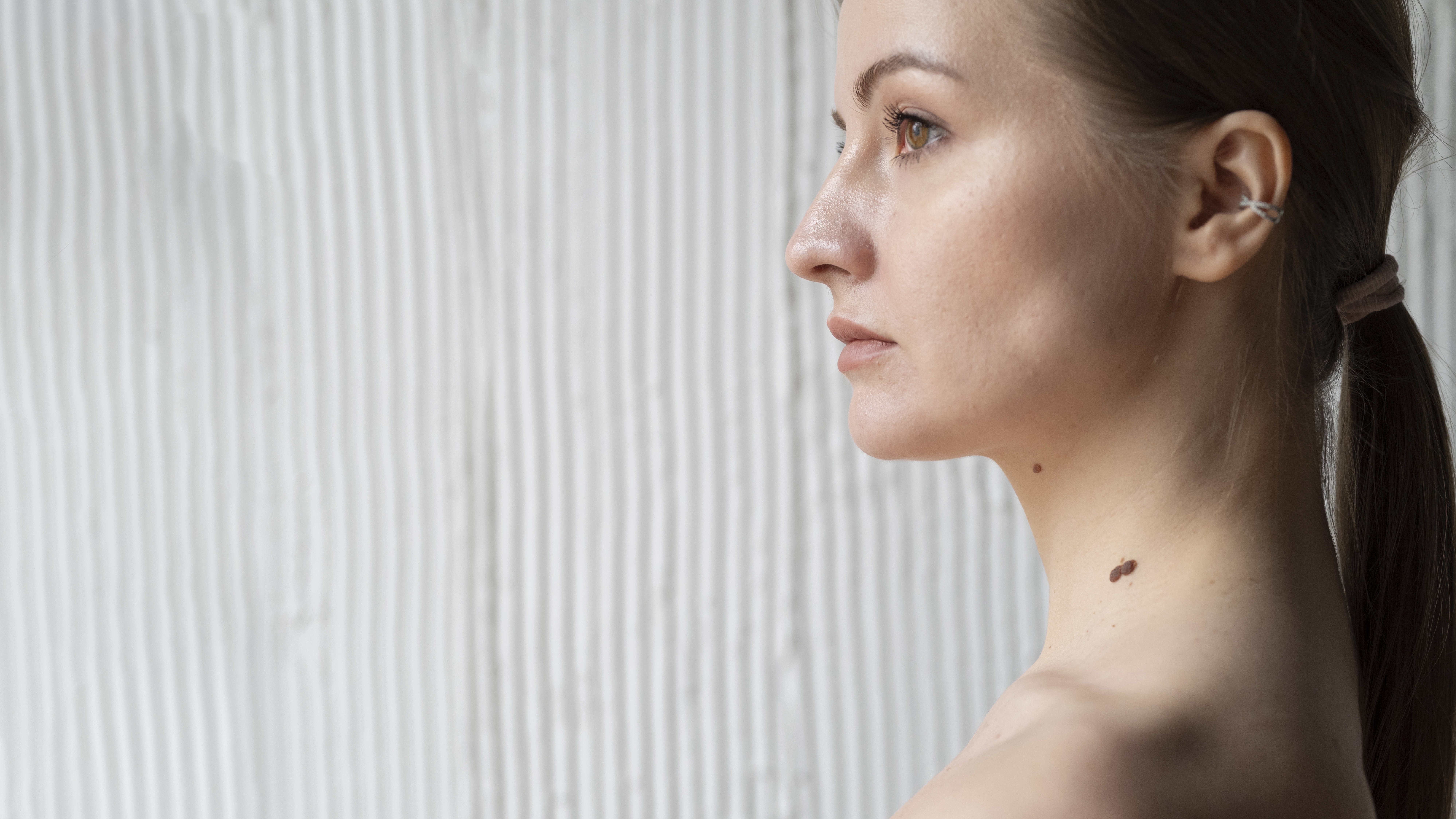 Ung thư hắc tố thường diễn tiến âm thầm nhưng có thể di căn sớm