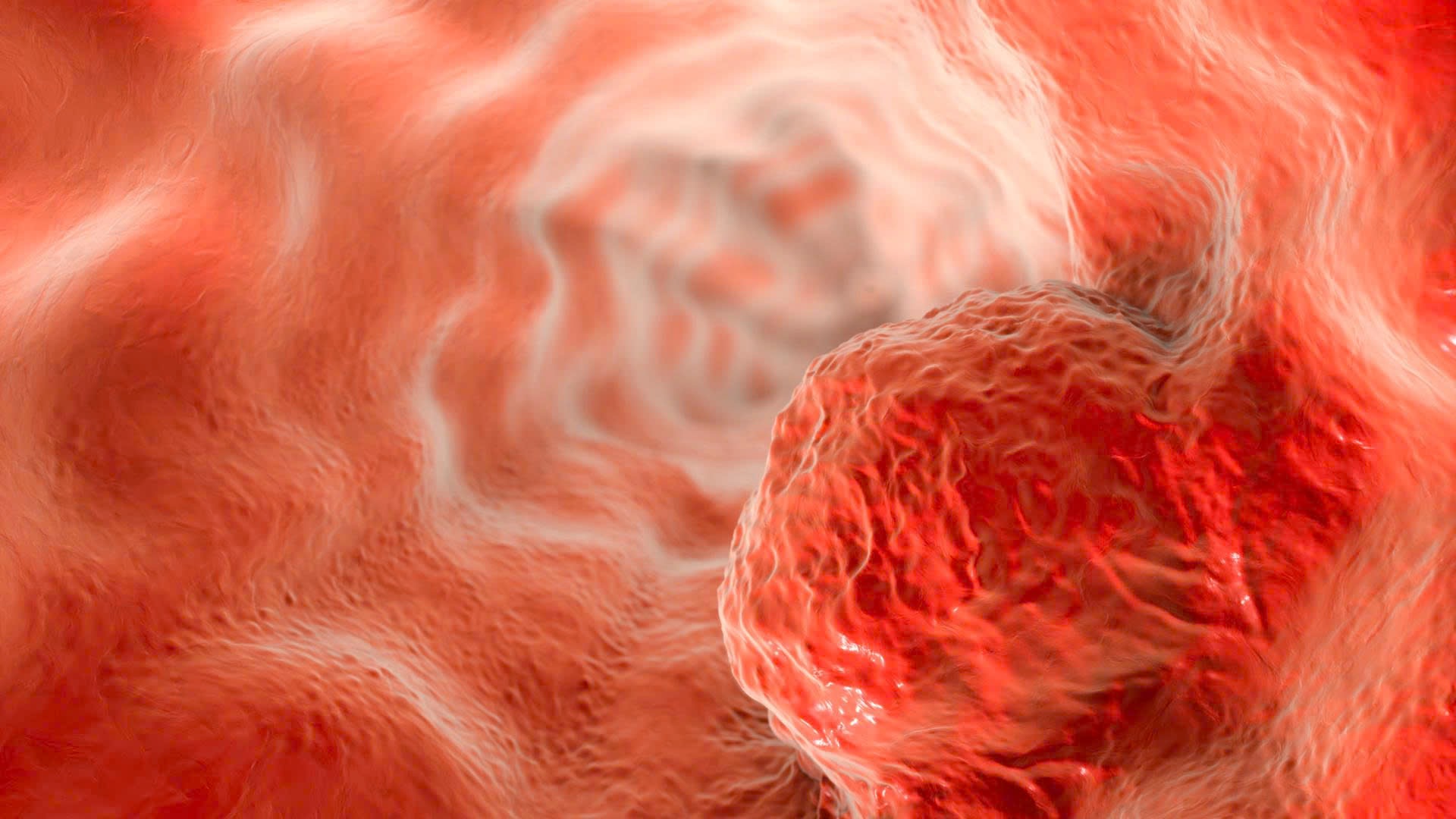 Ung thư thực quản giai đoạn II được chia thành hai mức độ