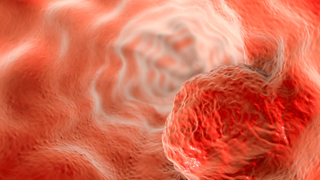 Ung thư thực quản giai đoạn 3 là thời kỳ bệnh đã lan rộng trong thành thực quản