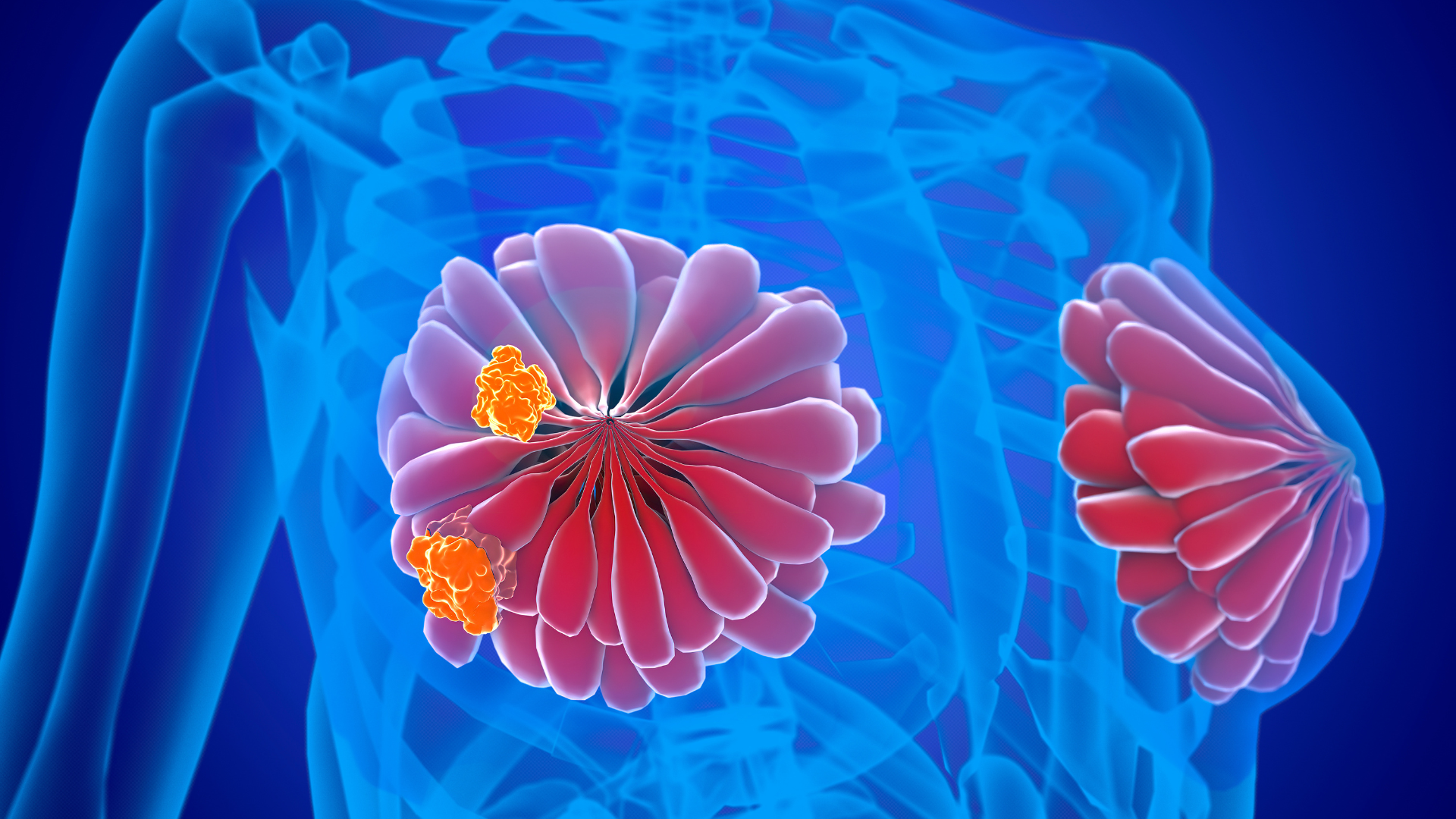 Khối u ung thư vú thường cứng, chắc , bề mặt gồ ghề hơn so với khối u lành tính