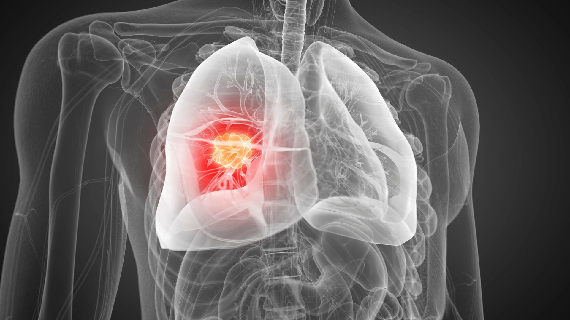 Ung thư vú di căn phổi khi tế bào ung thư từ vú xâm lấn sang phổi