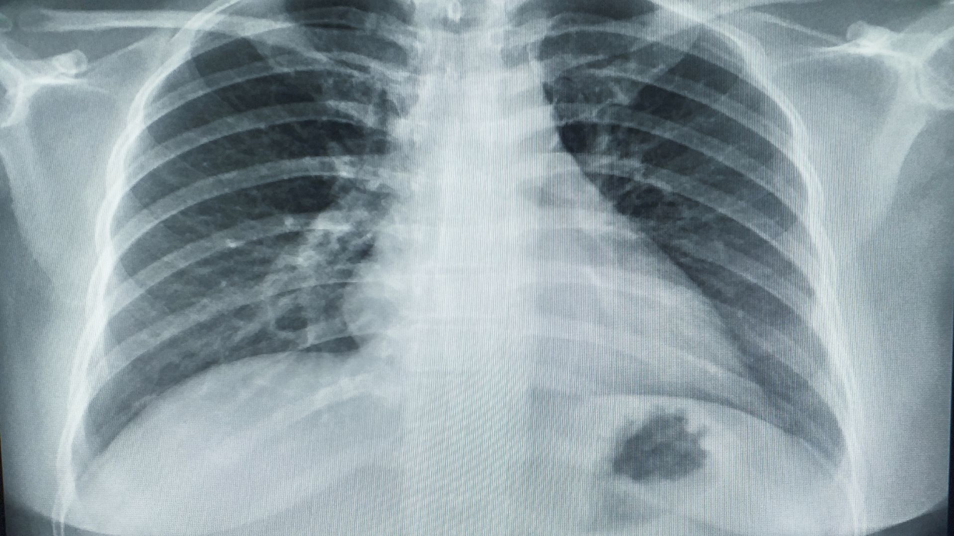 Chụp X-quang phổi hỗ trợ chẩn đoán khi nghi ngờ tế bào ung thư di căn đến phổi