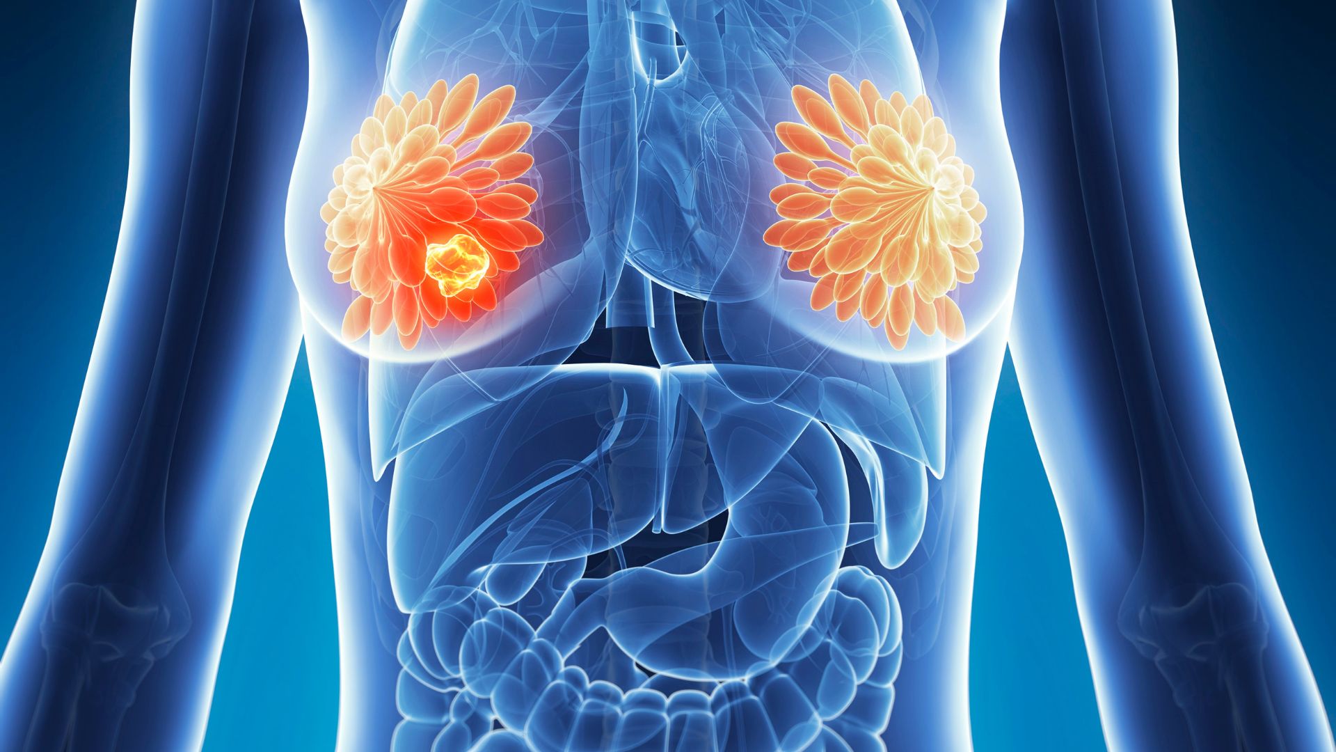 Ung thư vú di căn xương sống được bao lâu