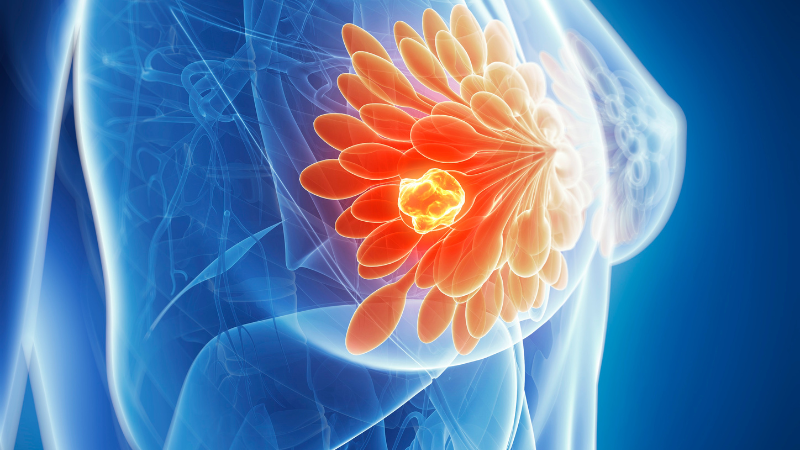 Triệu chứng ung thư vú giai đoạn muộn bao gồm khối u lớn và di căn