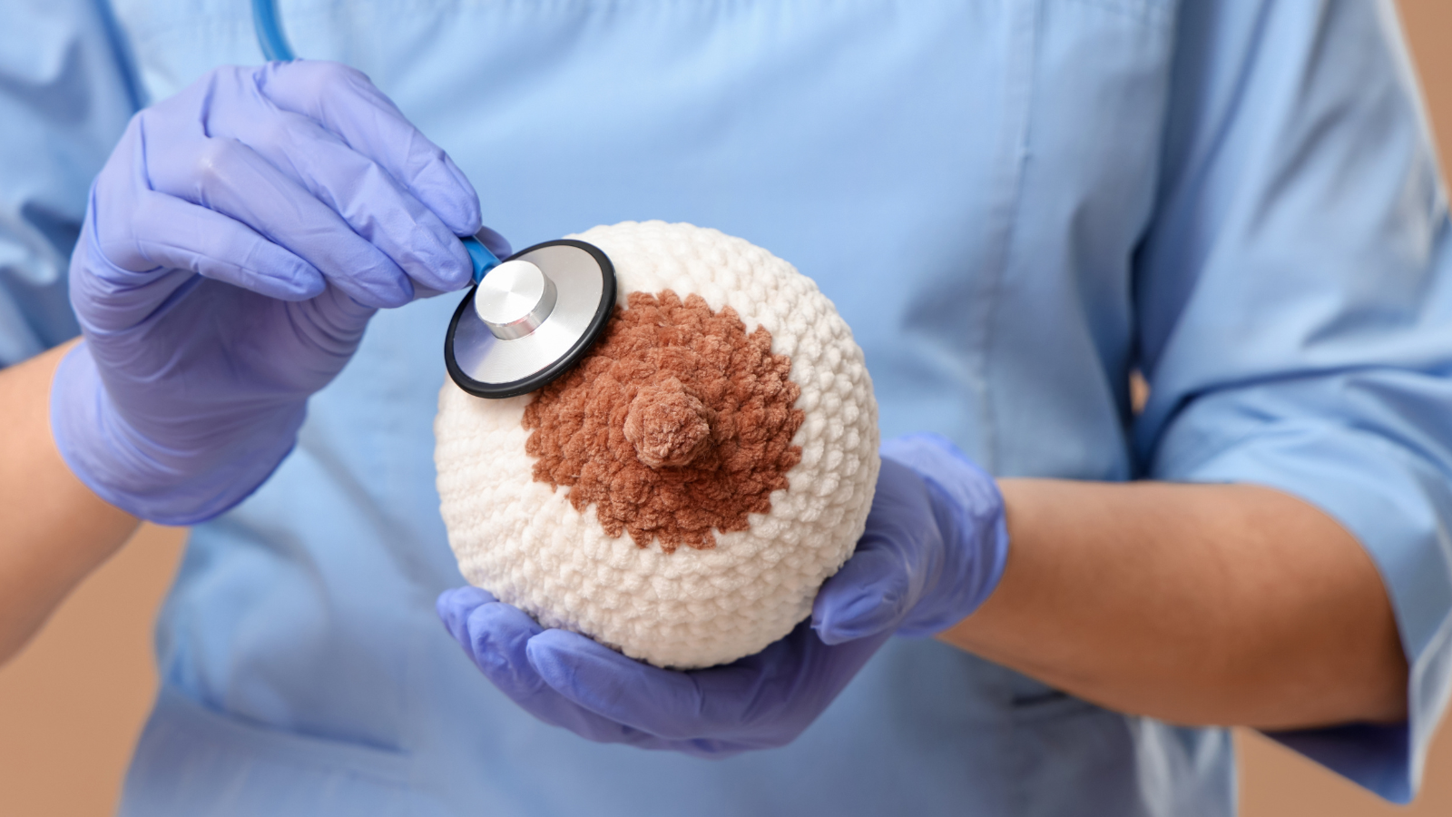 Ung thư vú tiến triển qua nhiều giai đoạn từ khởi phát đến di căn