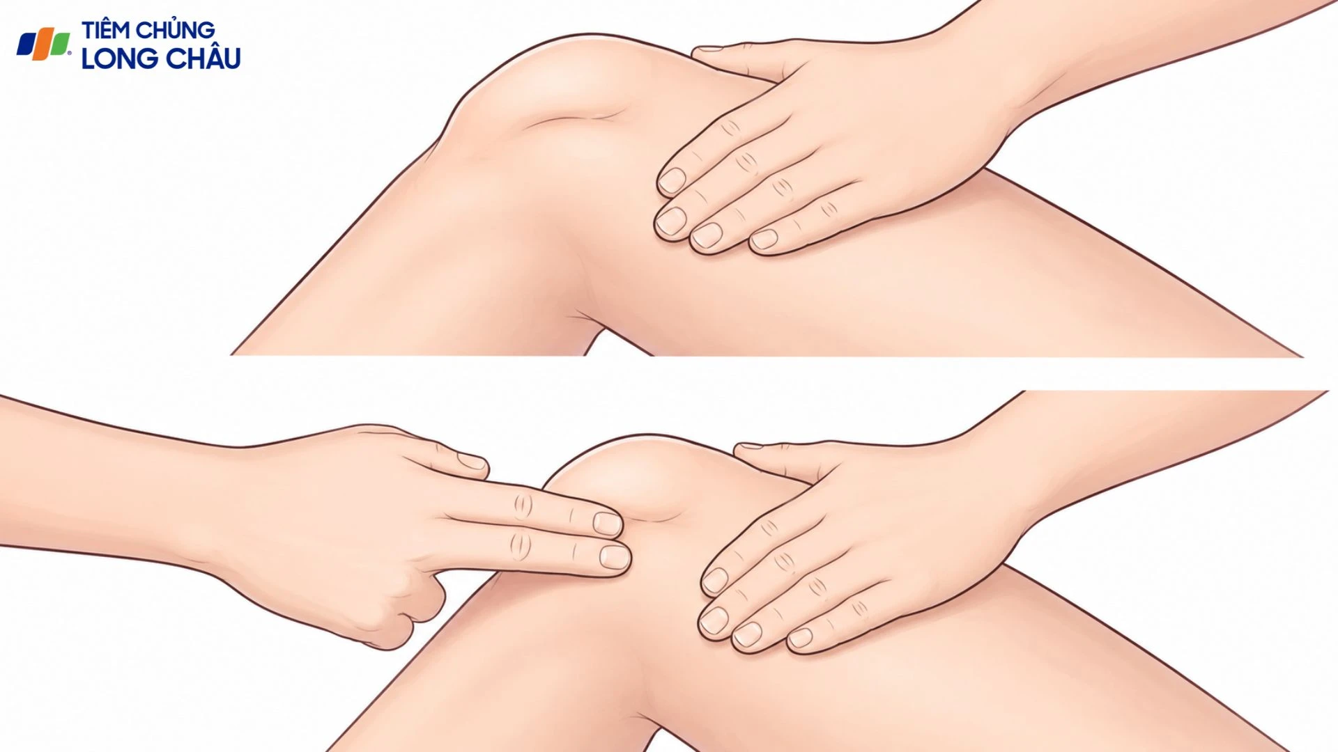 Bập bềnh xương bánh chè: Dấu hiệu cảnh báo bệnh lý khớp gối