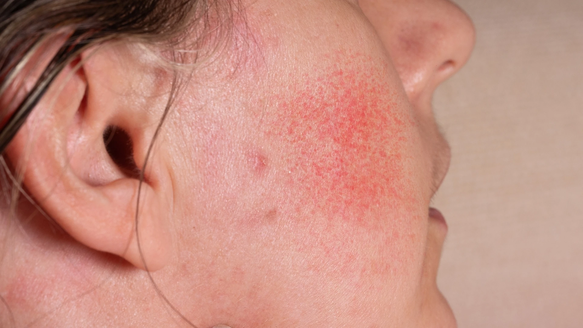benh_a_z_benh_rosacea_0_3f87028a55