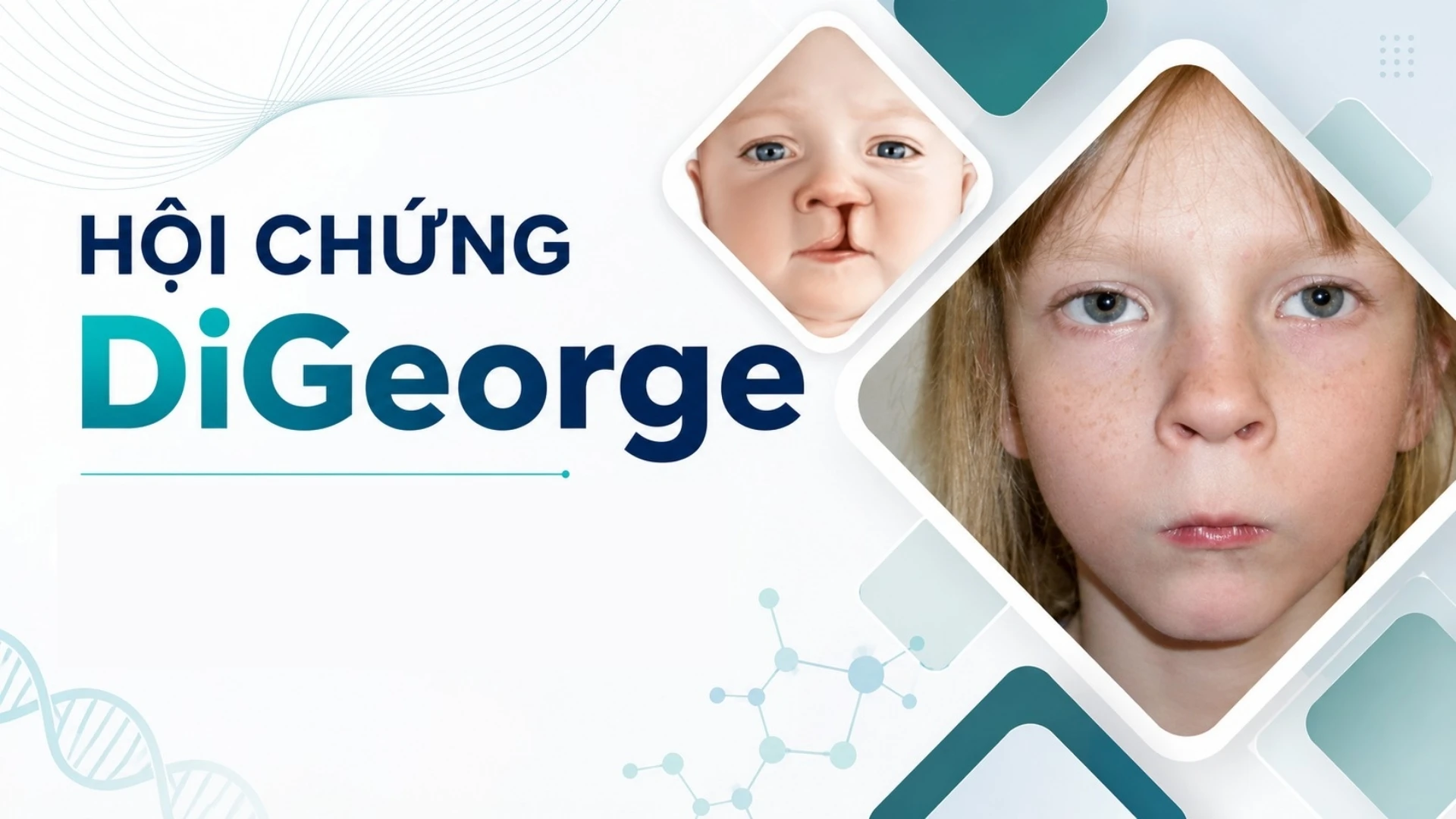 benh_a_z_hoi_chung_di_george_1_3bcf6538d0