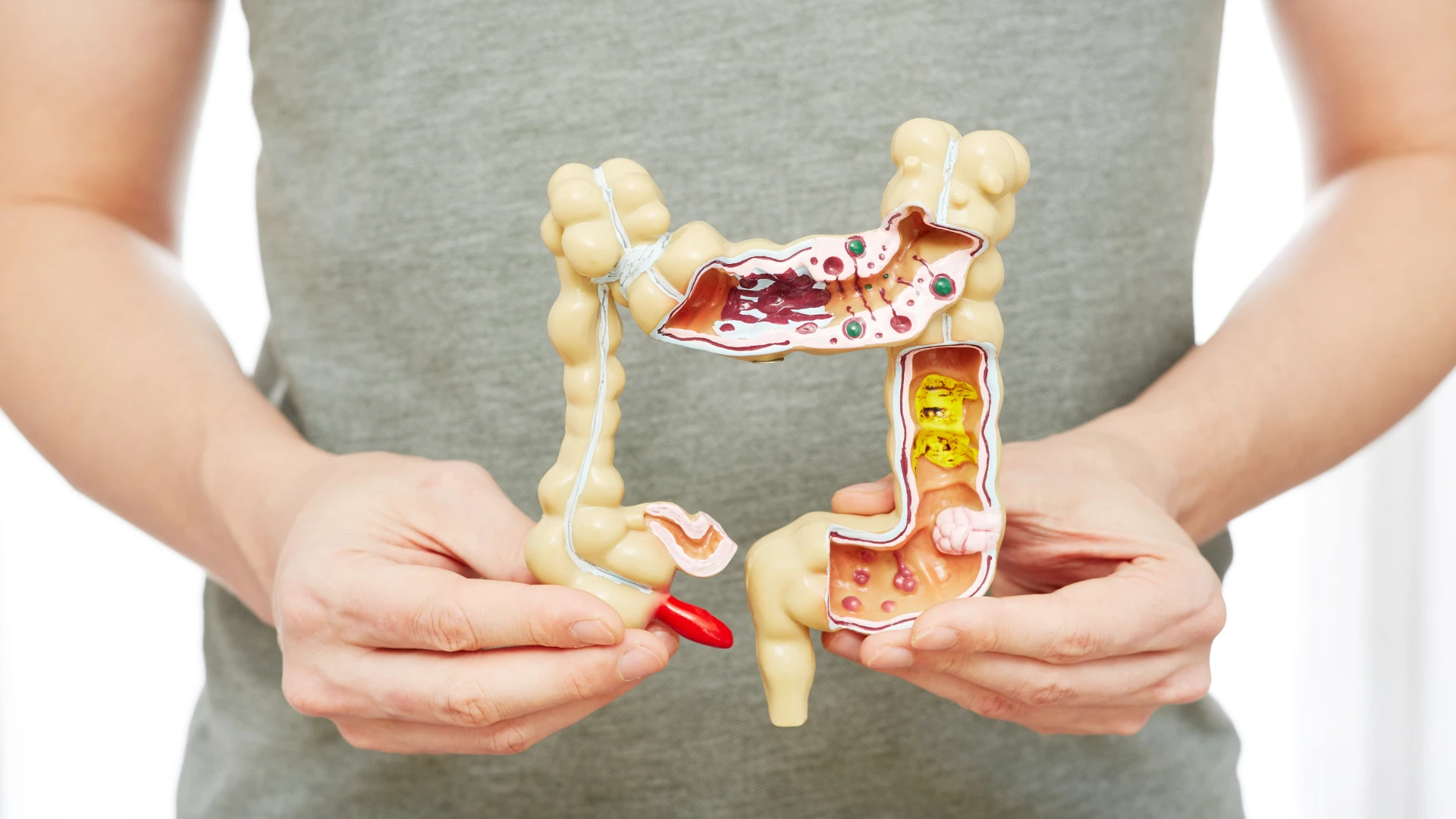 benh_crohn_dai_trang_1_cef0aabfc1