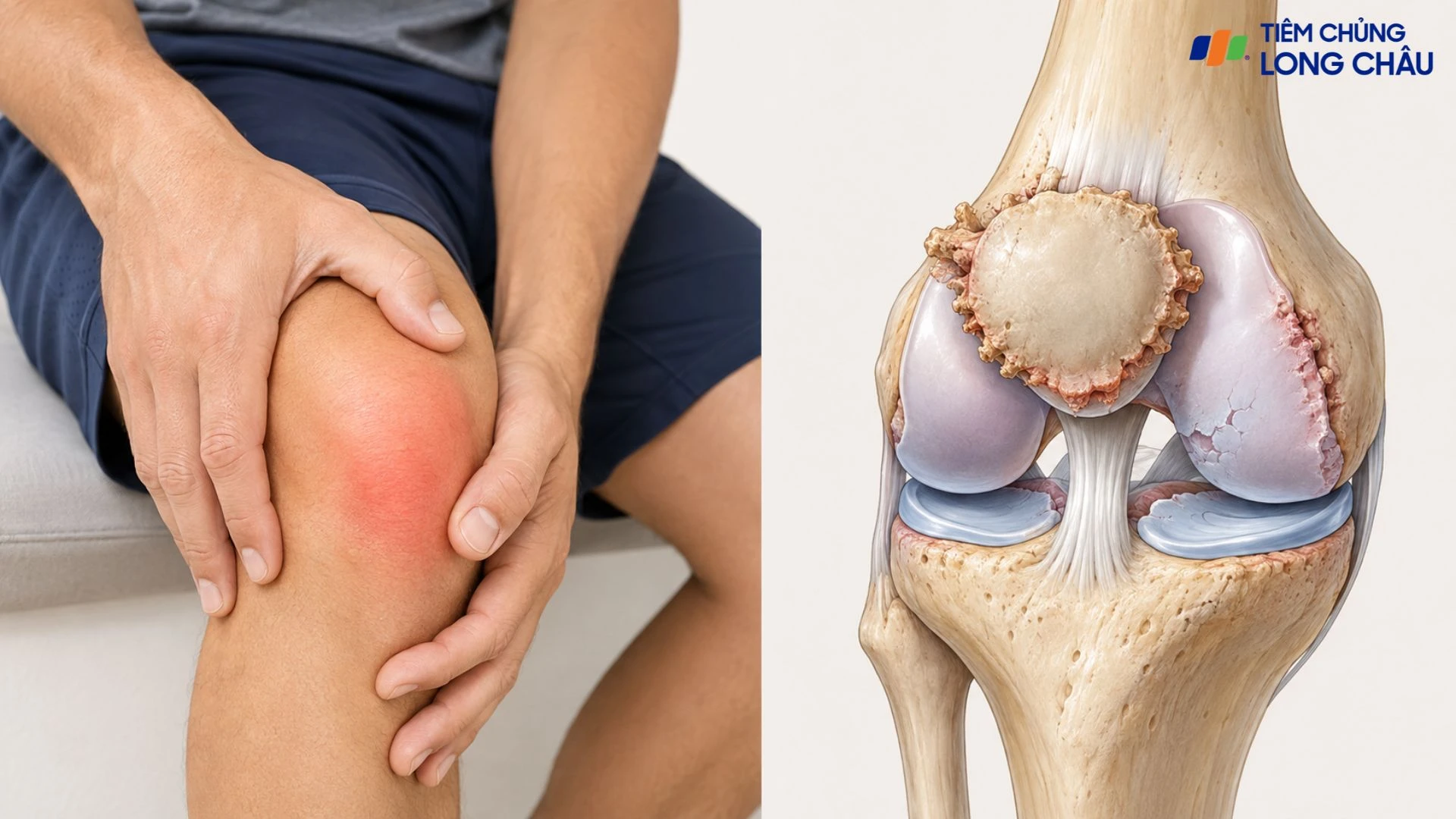 Gai xương bánh chè: Nguyên nhân, triệu chứng và cách điều trị