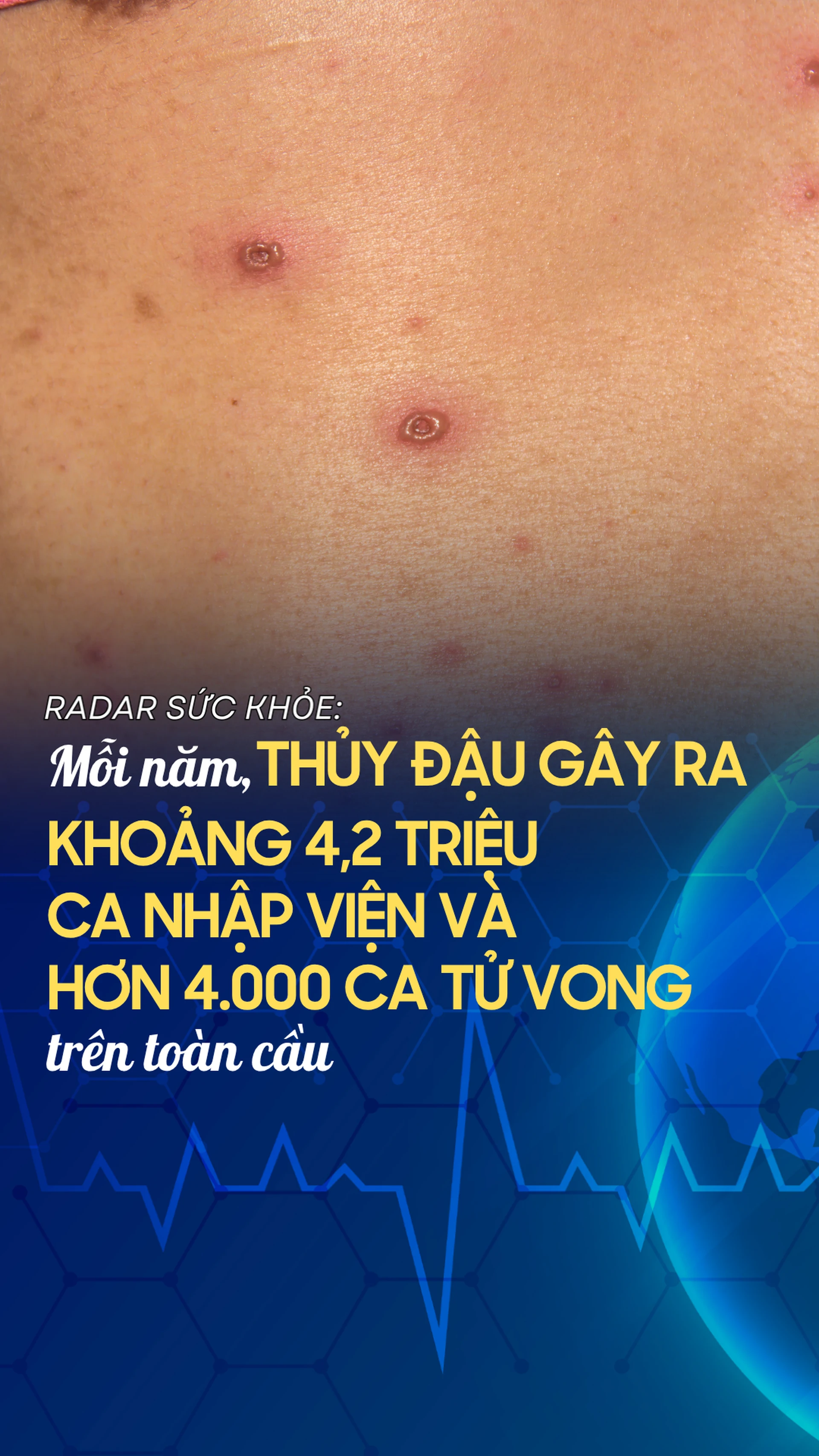 moi_nam_thuy_dau_gay_khoang_4_2_trieu_ca_nhap_vien_va_hon_4_000_ca_tu_vong_tren_toan_cau_e25eb125ae