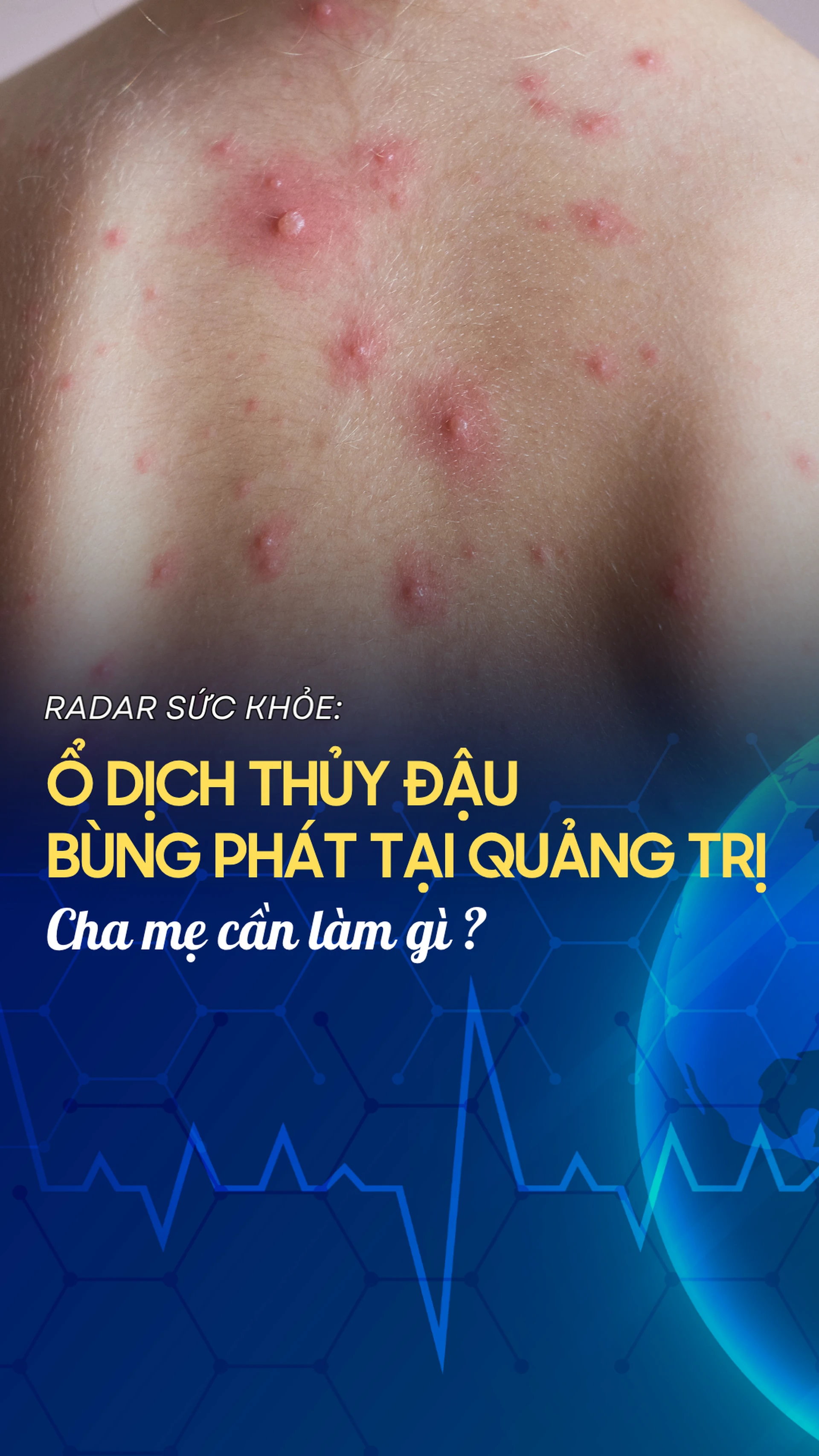 o_dich_thuy_dau_bung_phat_tai_quang_tri_cha_me_can_lam_gi_d0d2dd66ba