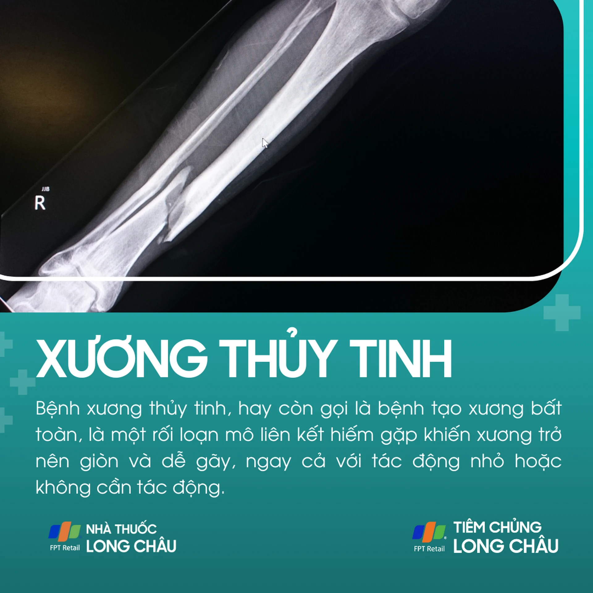 xuong_thuy_tinh_1_5ad8fb15a6