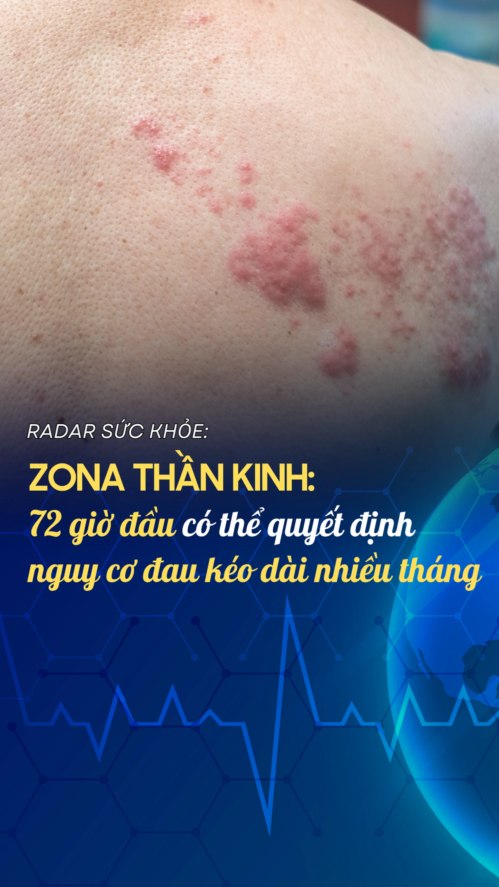 zona_than_kinh_72_gio_dau_co_the_quyet_dinh_nguy_co_dau_keo_dai_nhieu_thang_4cca6c12bf