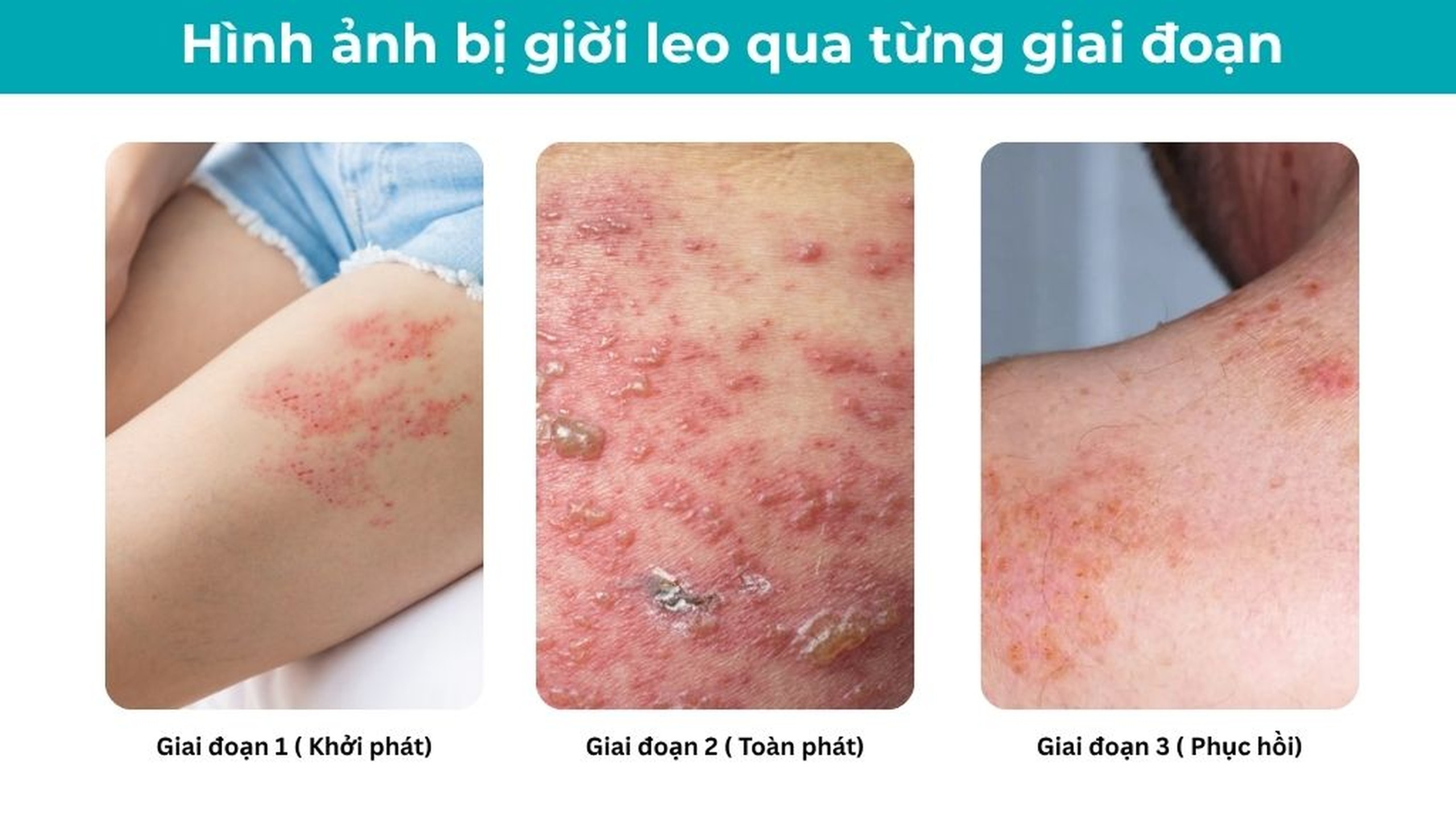 Hình ảnh bị giời leo qua từng giai đoạn