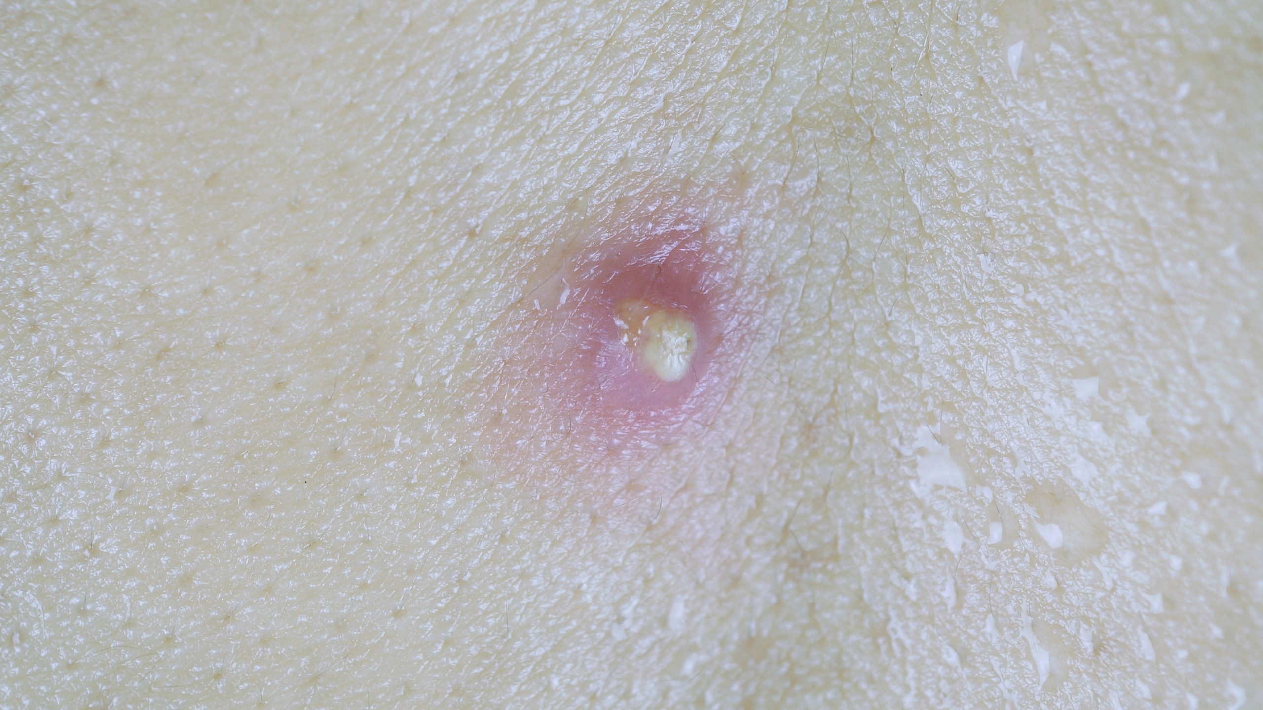 U bã đậu: Dấu hiệu, nguyên nhân, phương pháp chẩn đoán, điều trị và phòng ngừa